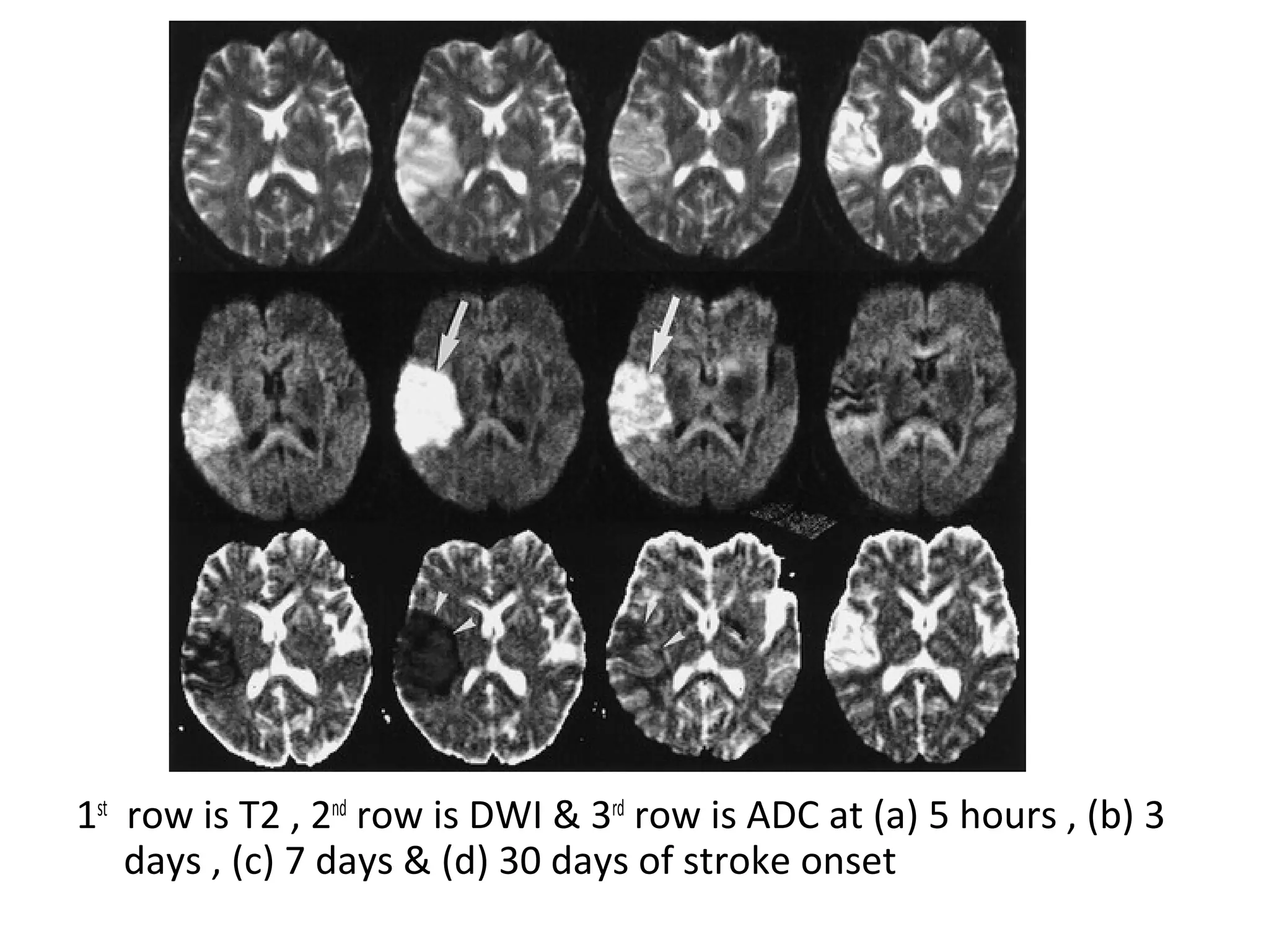 1st
row is T2 , 2nd
row is DWI & 3rd
row is ADC at (a) 5 hours , (b) 3
days , (c) 7 days & (d) 30 days of stroke onset
 