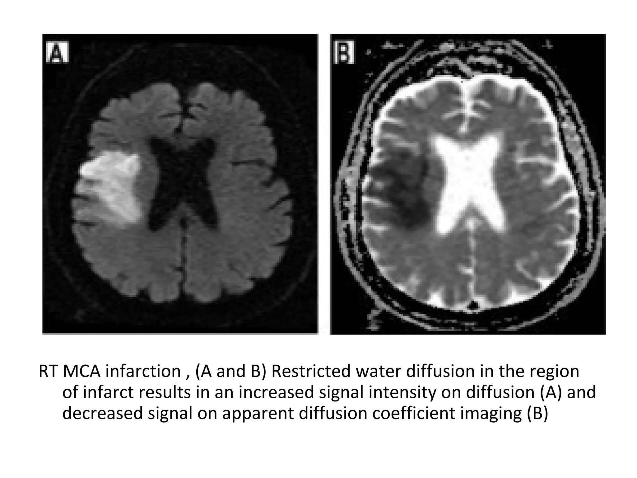 RT MCA infarction , (A and B) Restricted water diffusion in the region
of infarct results in an increased signal intensity on diffusion (A) and
decreased signal on apparent diffusion coefficient imaging (B)
 