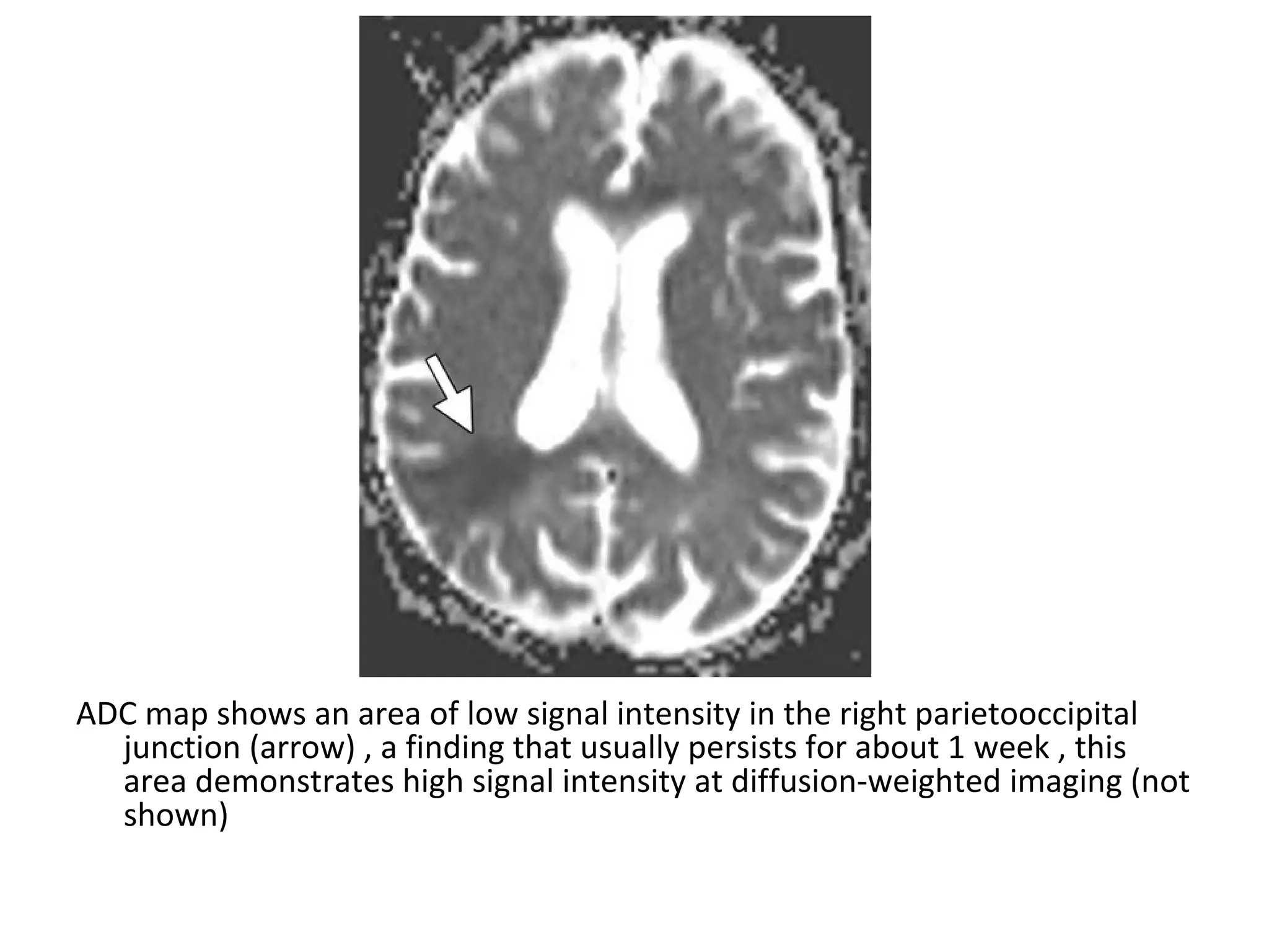 ADC map shows an area of low signal intensity in the right parietooccipital
junction (arrow) , a finding that usually persists for about 1 week , this
area demonstrates high signal intensity at diffusion-weighted imaging (not
shown)
 