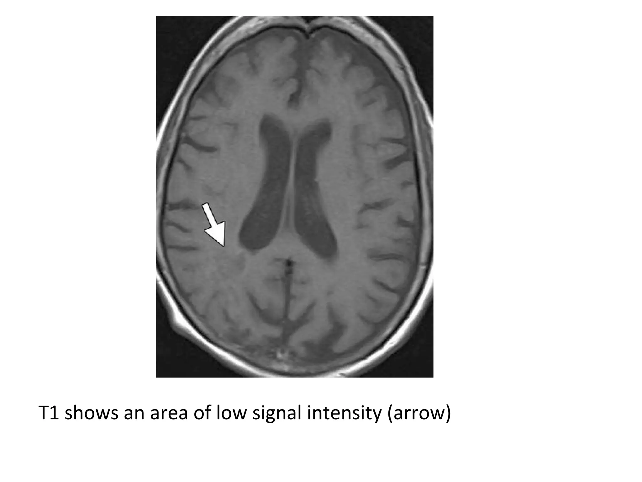 T1 shows an area of low signal intensity (arrow)
 