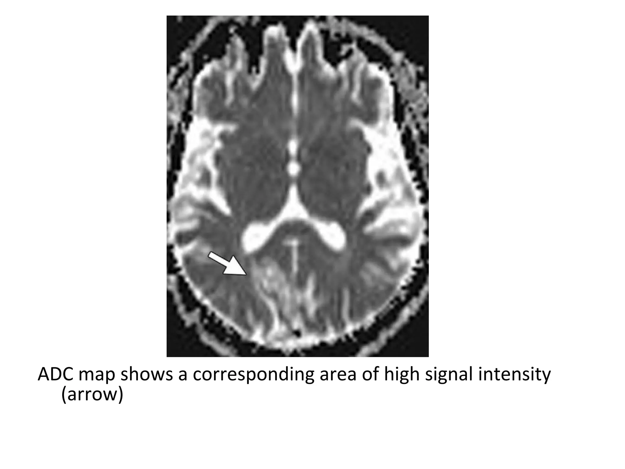 ADC map shows a corresponding area of high signal intensity
(arrow)
 