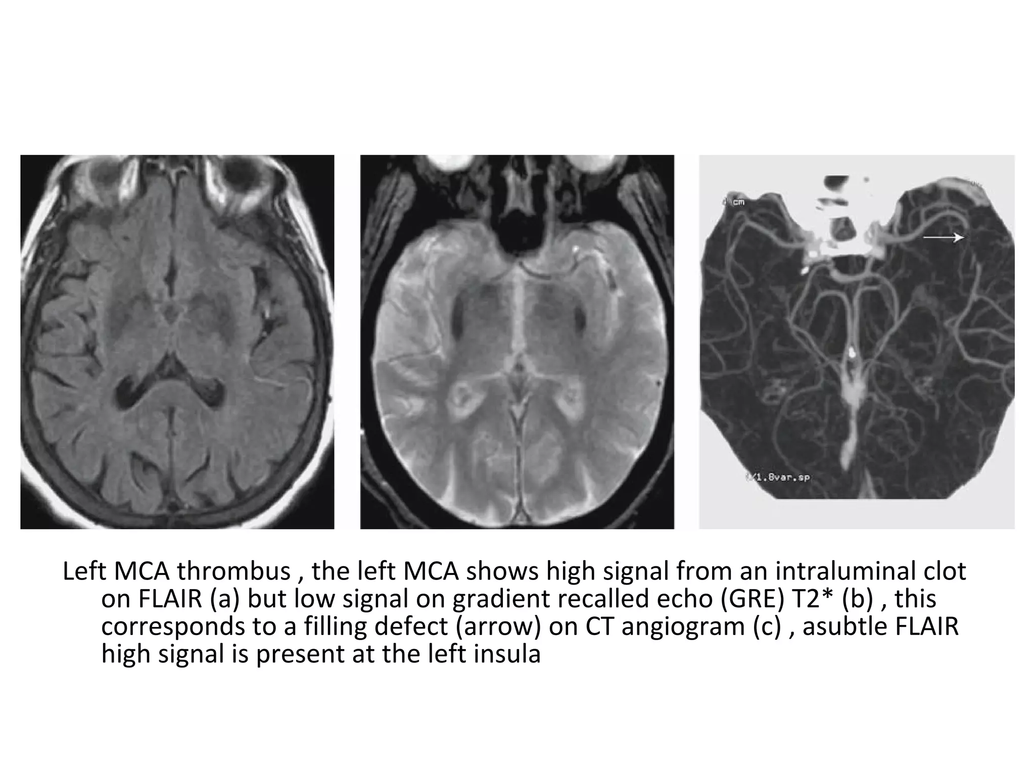 Left MCA thrombus , the left MCA shows high signal from an intraluminal clot
on FLAIR (a) but low signal on gradient recalled echo (GRE) T2* (b) , this
corresponds to a filling defect (arrow) on CT angiogram (c) , asubtle FLAIR
high signal is present at the left insula
 