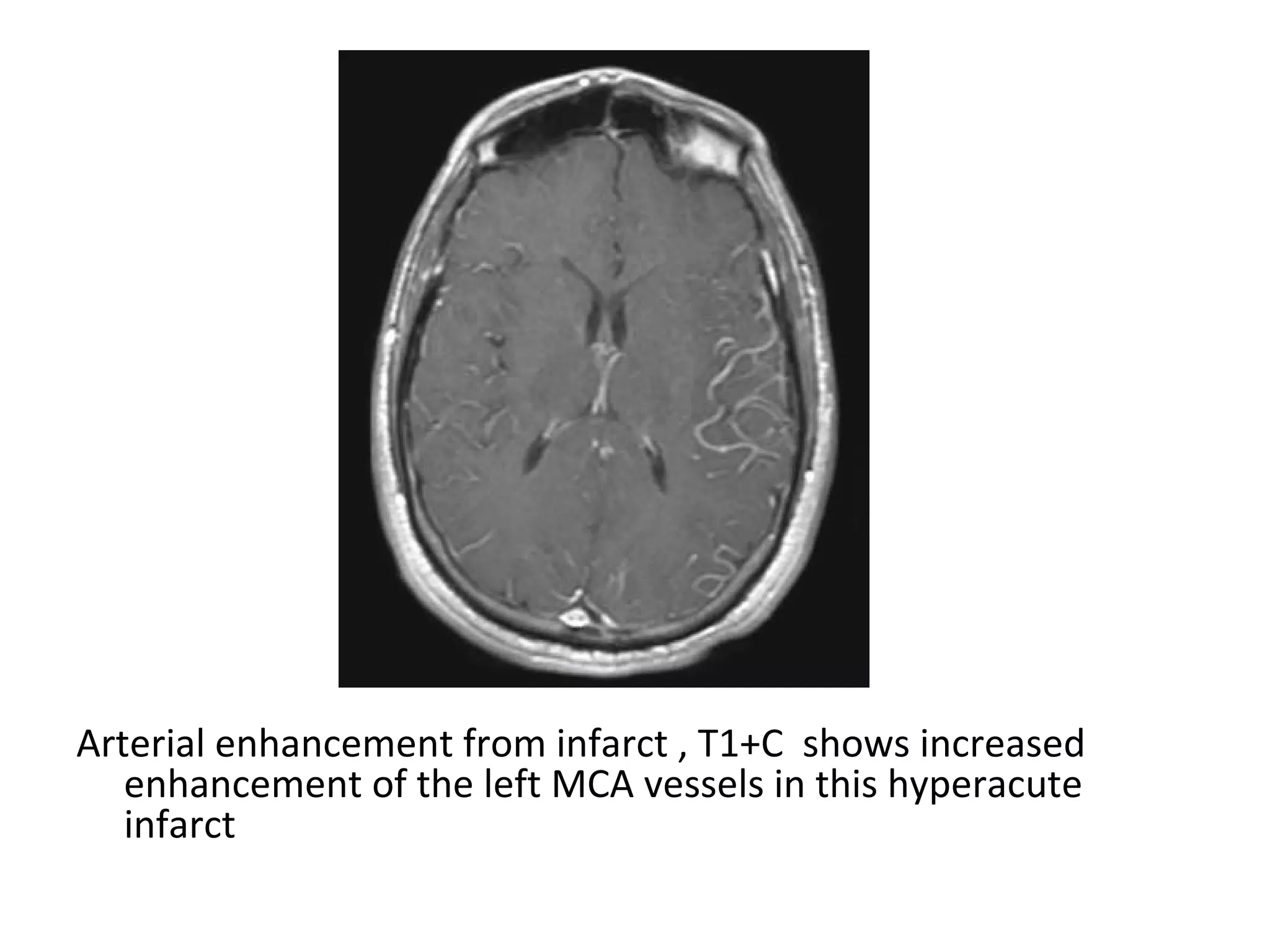 Arterial enhancement from infarct , T1+C shows increased
enhancement of the left MCA vessels in this hyperacute
infarct
 