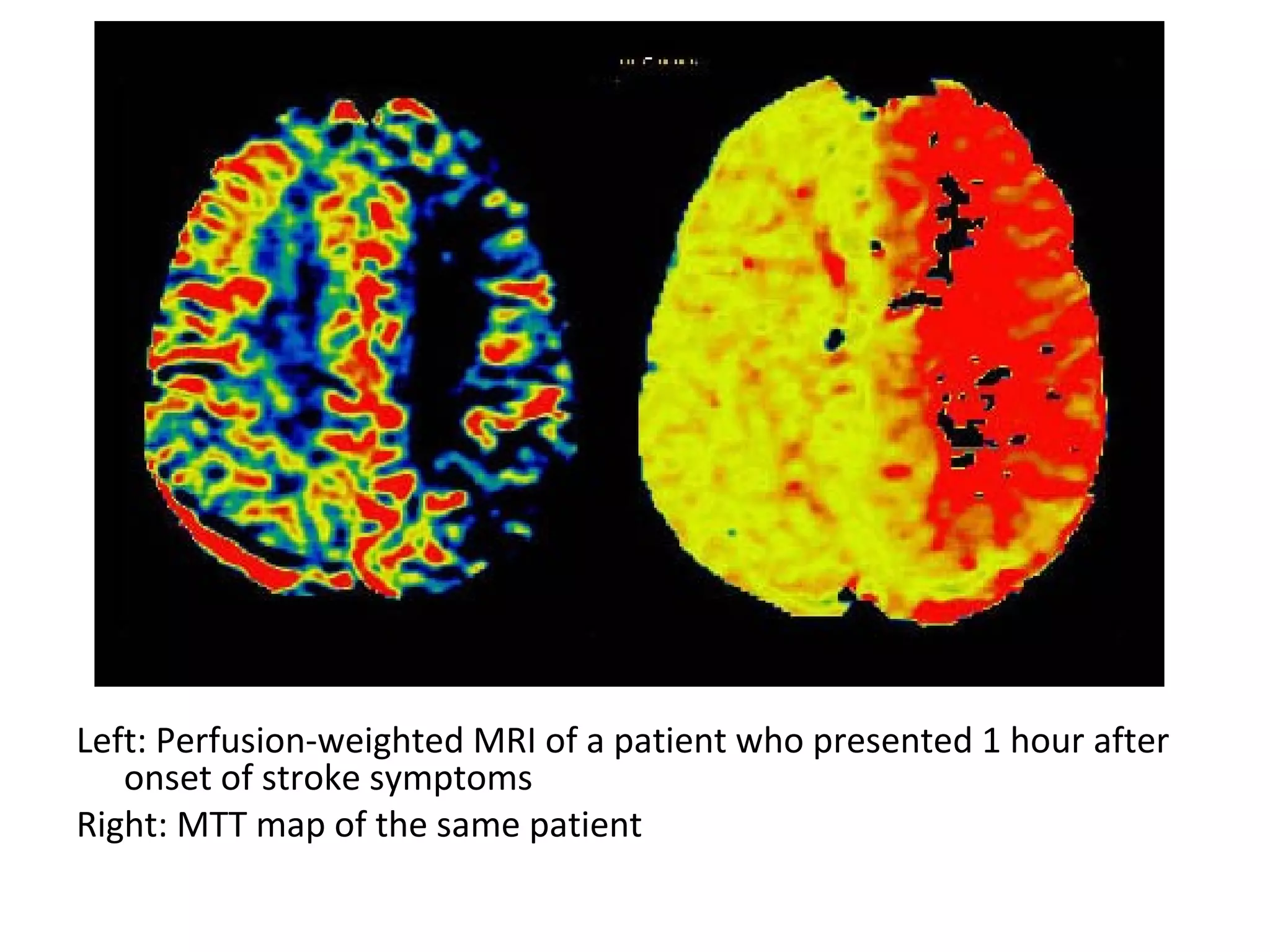 Left: Perfusion-weighted MRI of a patient who presented 1 hour after
onset of stroke symptoms
Right: MTT map of the same patient
 