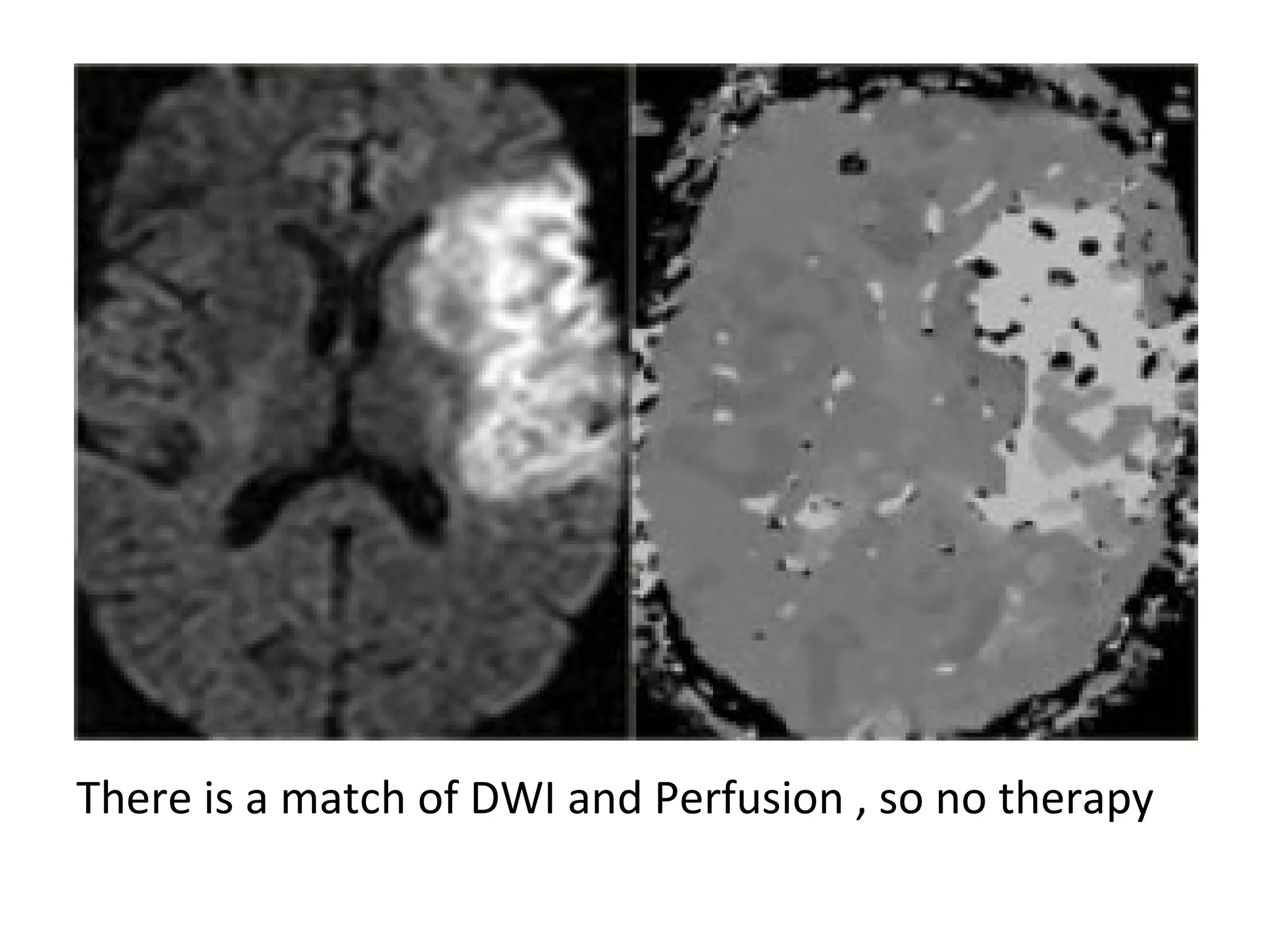 There is a match of DWI and Perfusion , so no therapy
 