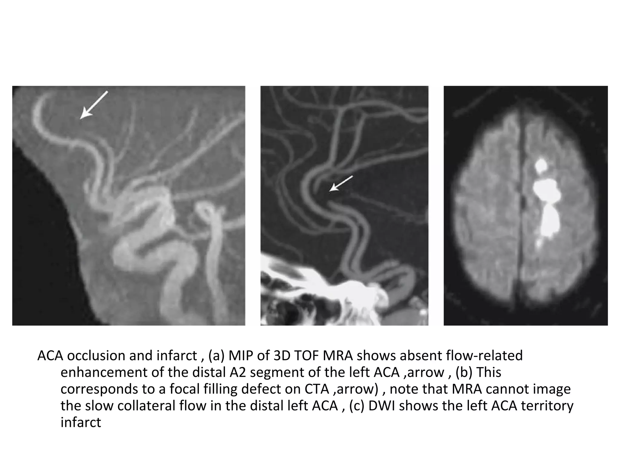 ACA occlusion and infarct , (a) MIP of 3D TOF MRA shows absent flow-related
enhancement of the distal A2 segment of the left ACA ,arrow , (b) This
corresponds to a focal filling defect on CTA ,arrow) , note that MRA cannot image
the slow collateral flow in the distal left ACA , (c) DWI shows the left ACA territory
infarct
 