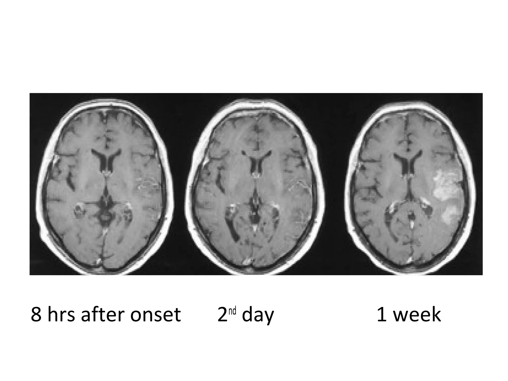 8 hrs after onset 2nd
day 1 week
 
