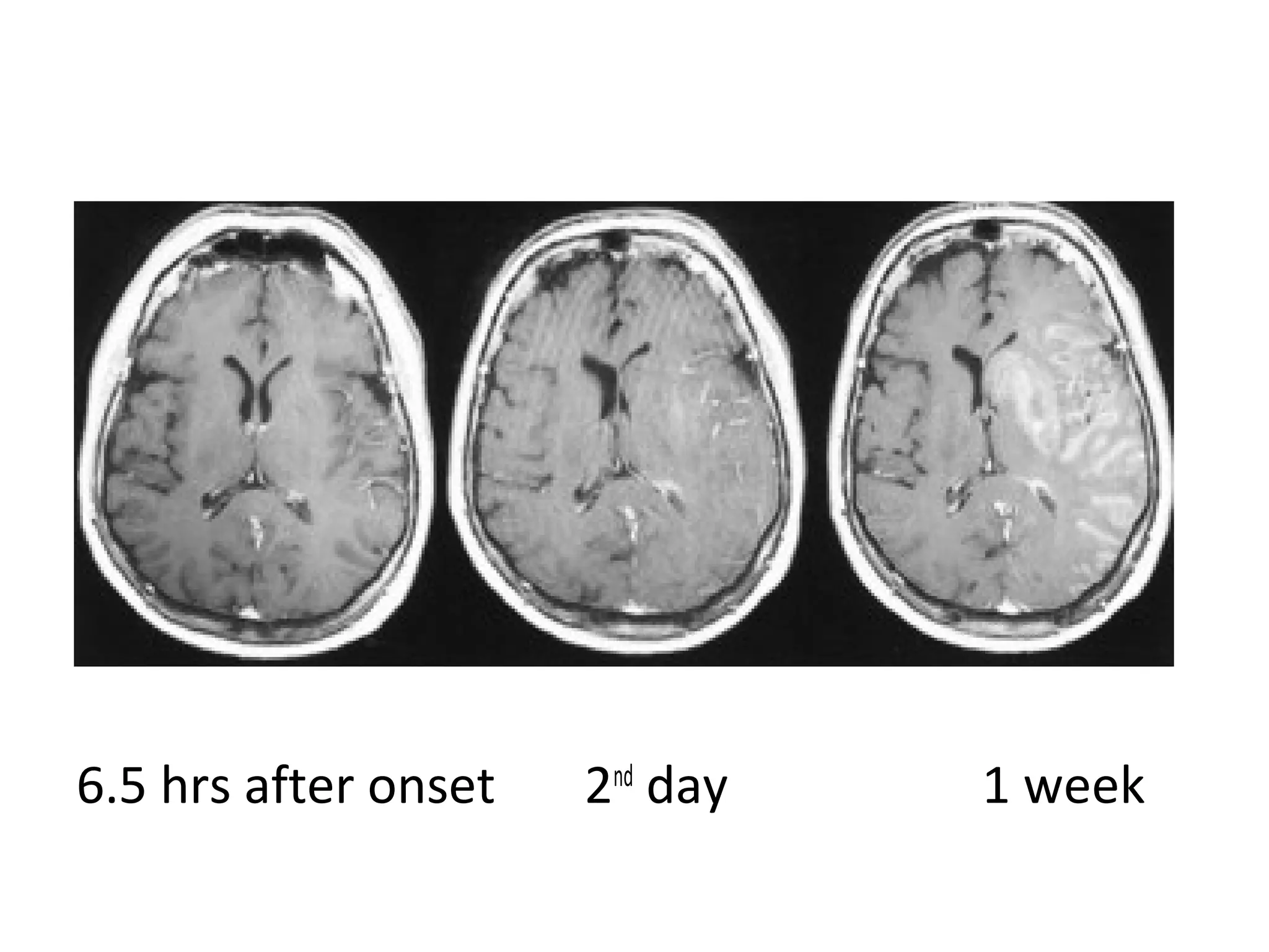 6.5 hrs after onset 2nd
day 1 week
 