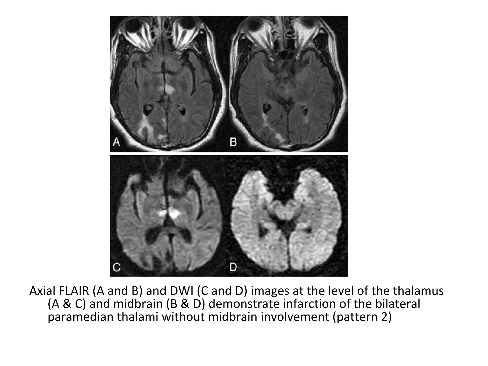 Axial FLAIR (A and B) and DWI (C and D) images at the level of the thalamus
(A & C) and midbrain (B & D) demonstrate infarction of the bilateral
paramedian thalami without midbrain involvement (pattern 2)
 