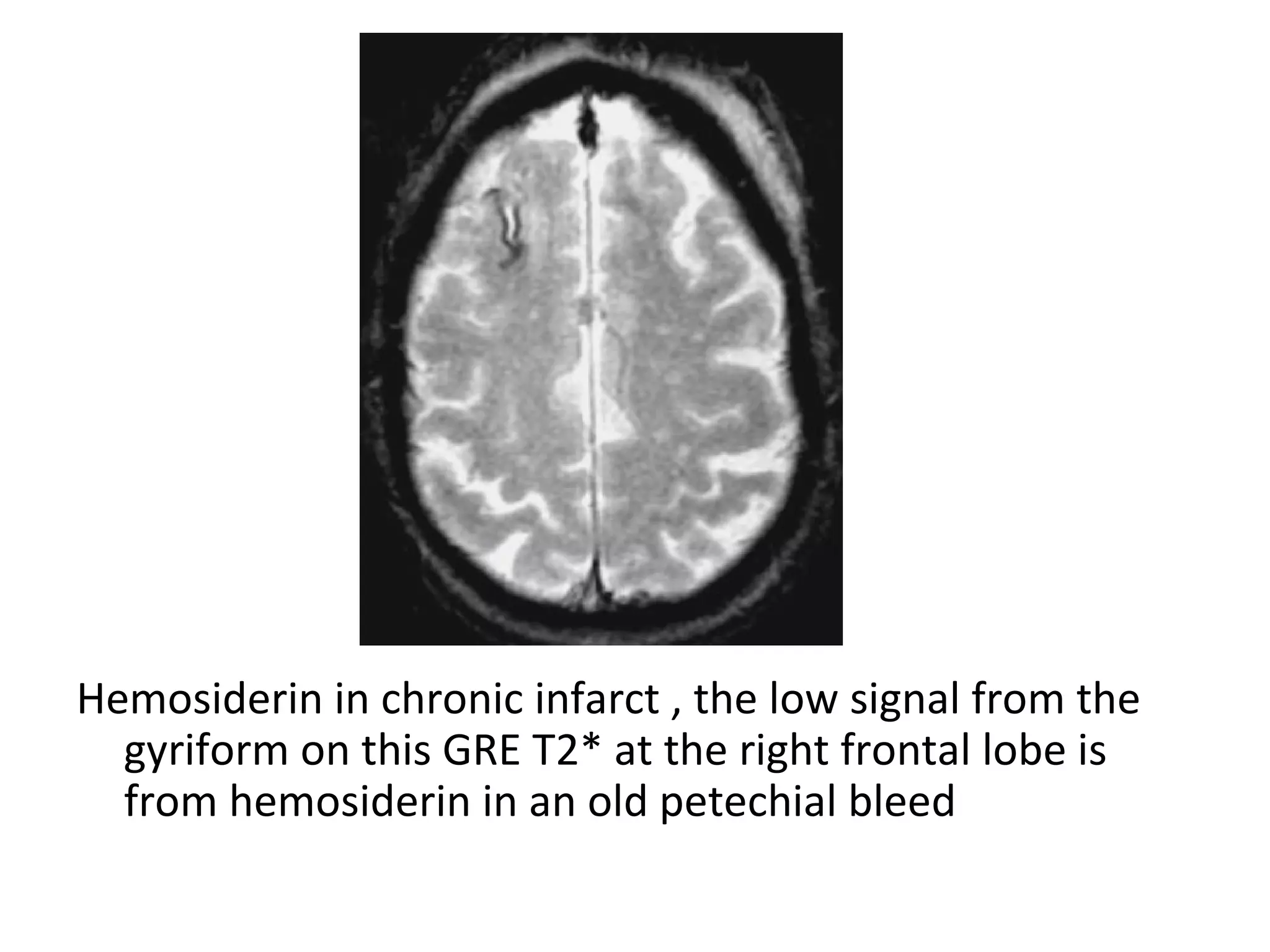 Hemosiderin in chronic infarct , the low signal from the
gyriform on this GRE T2* at the right frontal lobe is
from hemosiderin in an old petechial bleed
 