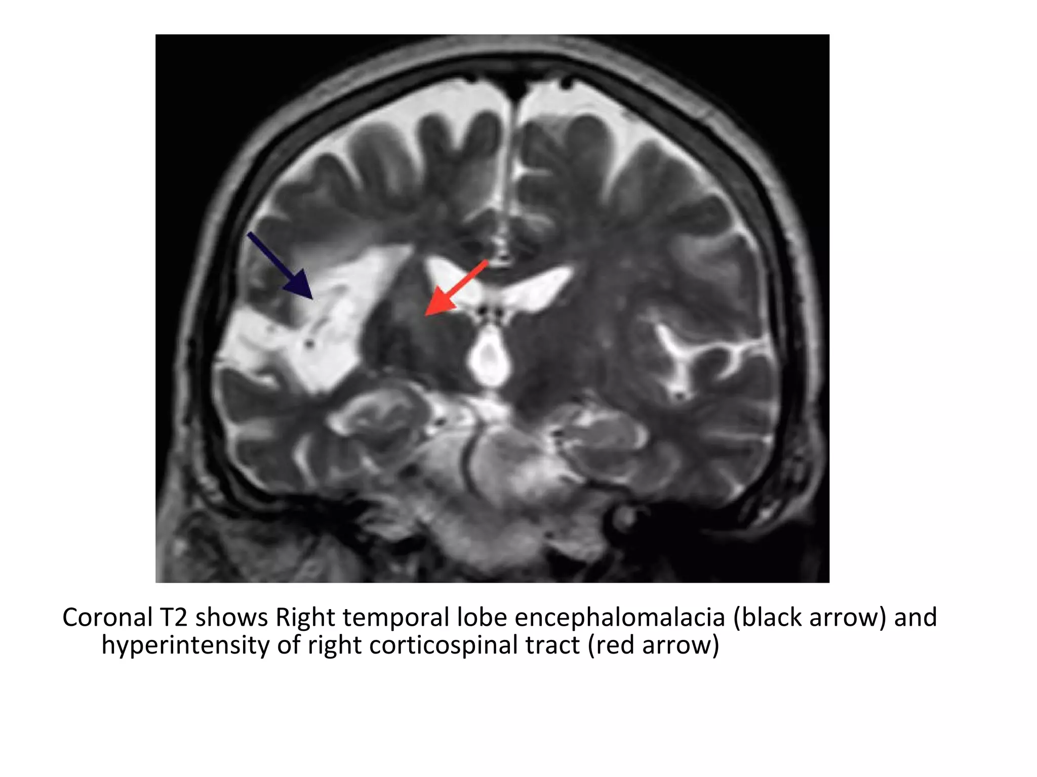 Coronal T2 shows Right temporal lobe encephalomalacia (black arrow) and
hyperintensity of right corticospinal tract (red arrow)
 