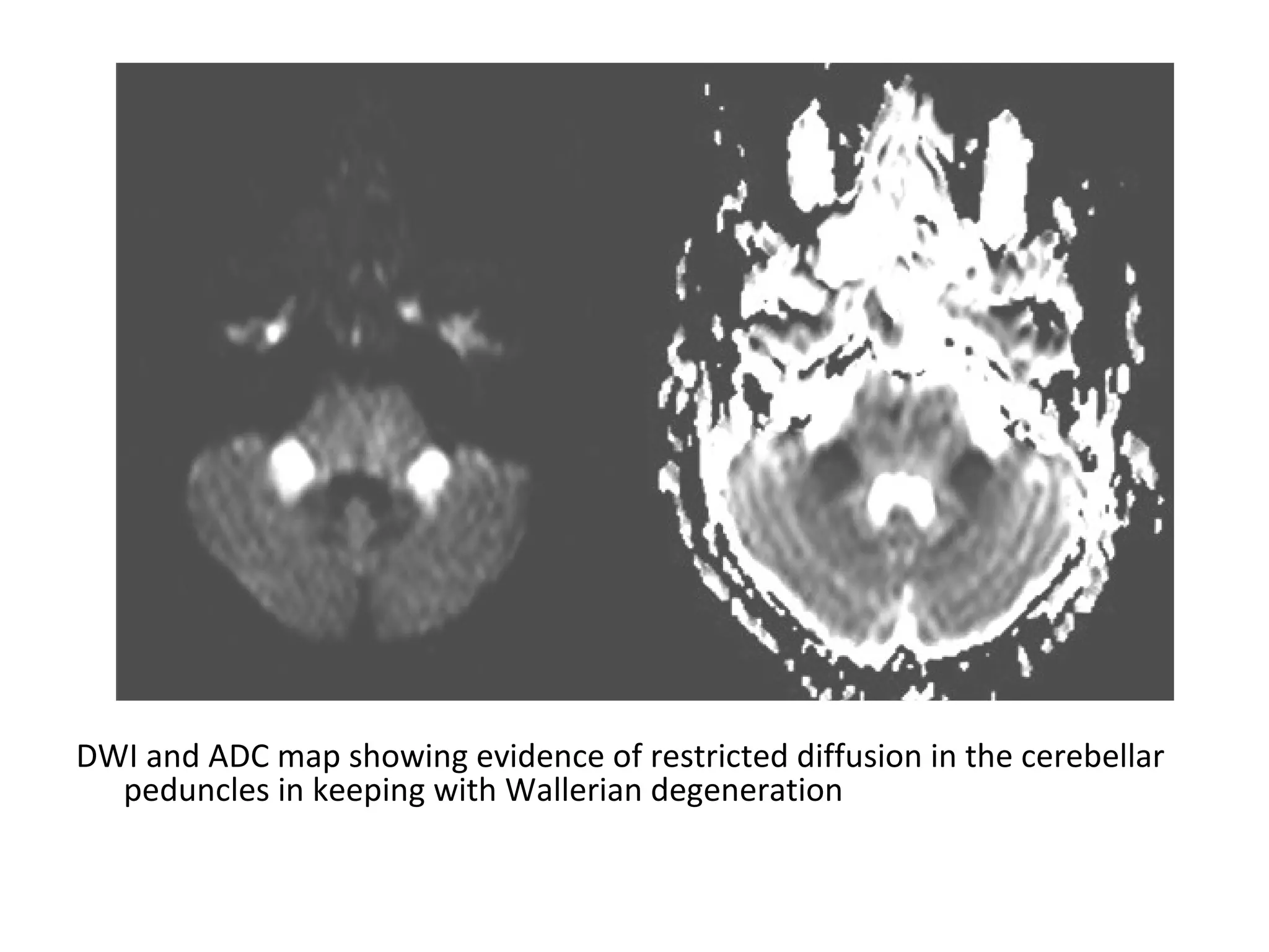 DWI and ADC map showing evidence of restricted diffusion in the cerebellar
peduncles in keeping with Wallerian degeneration
 