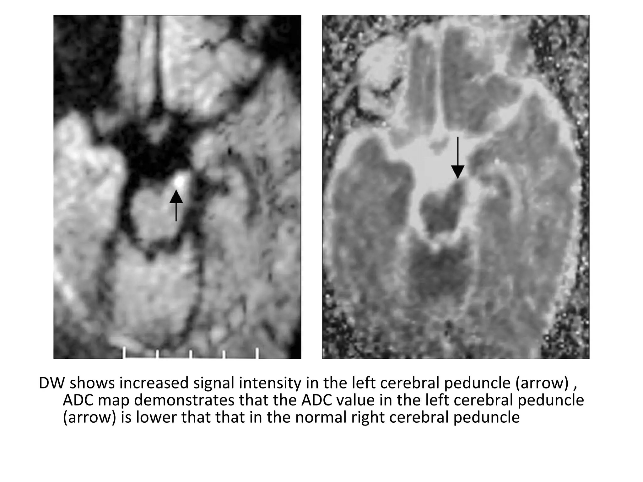 DW shows increased signal intensity in the left cerebral peduncle (arrow) ,
ADC map demonstrates that the ADC value in the left cerebral peduncle
(arrow) is lower that that in the normal right cerebral peduncle
 