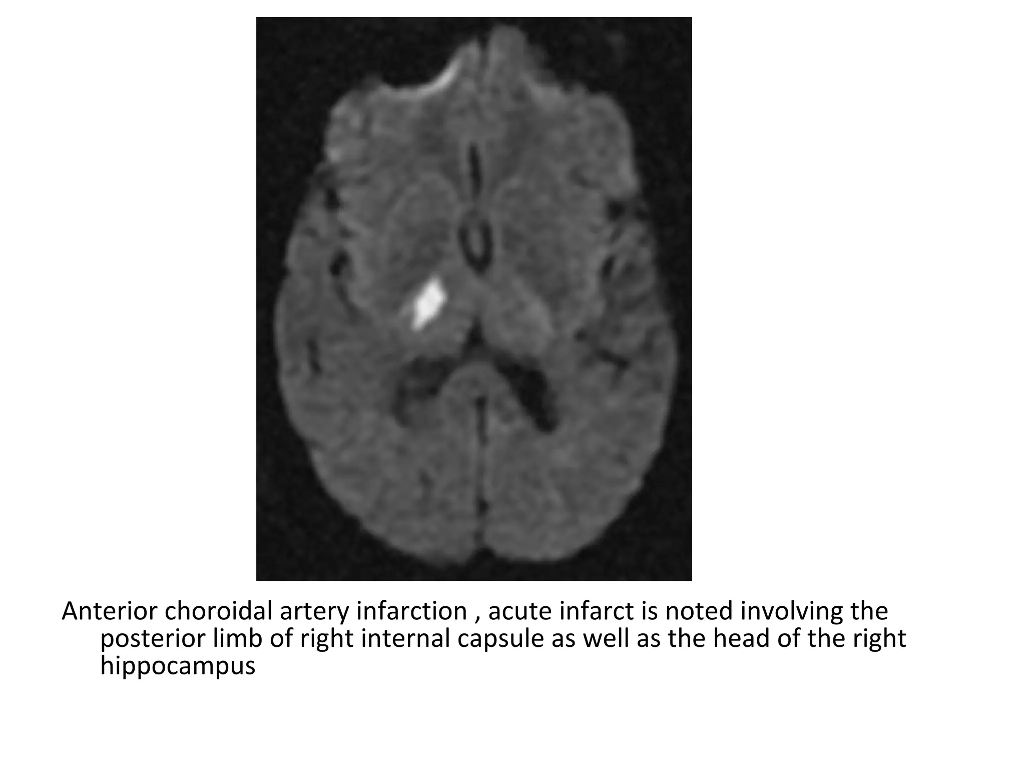 Anterior choroidal artery infarction , acute infarct is noted involving the
posterior limb of right internal capsule as well as the head of the right
hippocampus
 