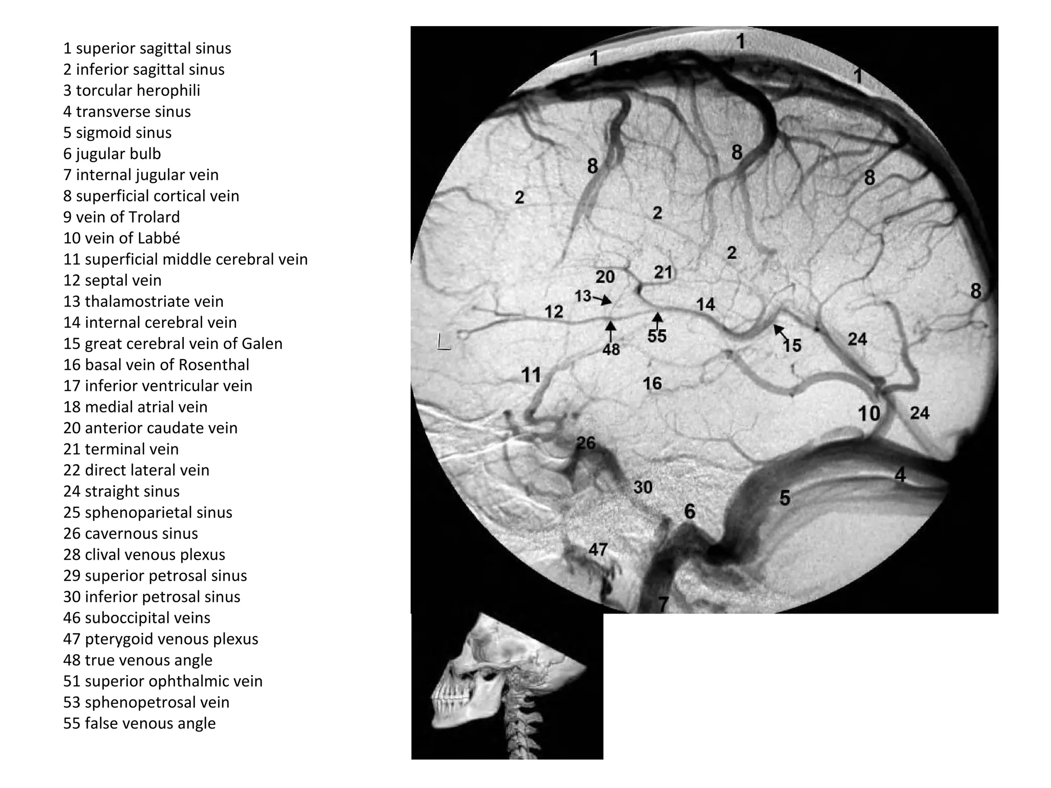 1 superior sagittal sinus
2 inferior sagittal sinus
3 torcular herophili
4 transverse sinus
5 sigmoid sinus
6 jugular bulb
7 internal jugular vein
8 superficial cortical vein
9 vein of Trolard
10 vein of Labbé
11 superficial middle cerebral vein
12 septal vein
13 thalamostriate vein
14 internal cerebral vein
15 great cerebral vein of Galen
16 basal vein of Rosenthal
17 inferior ventricular vein
18 medial atrial vein
20 anterior caudate vein
21 terminal vein
22 direct lateral vein
24 straight sinus
25 sphenoparietal sinus
26 cavernous sinus
28 clival venous plexus
29 superior petrosal sinus
30 inferior petrosal sinus
46 suboccipital veins
47 pterygoid venous plexus
48 true venous angle
51 superior ophthalmic vein
53 sphenopetrosal vein
55 false venous angle
 