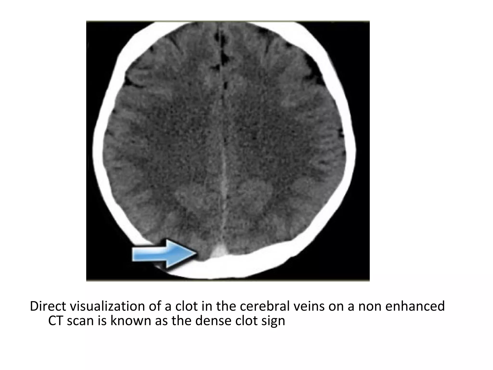 Direct visualization of a clot in the cerebral veins on a non enhanced
CT scan is known as the dense clot sign
 