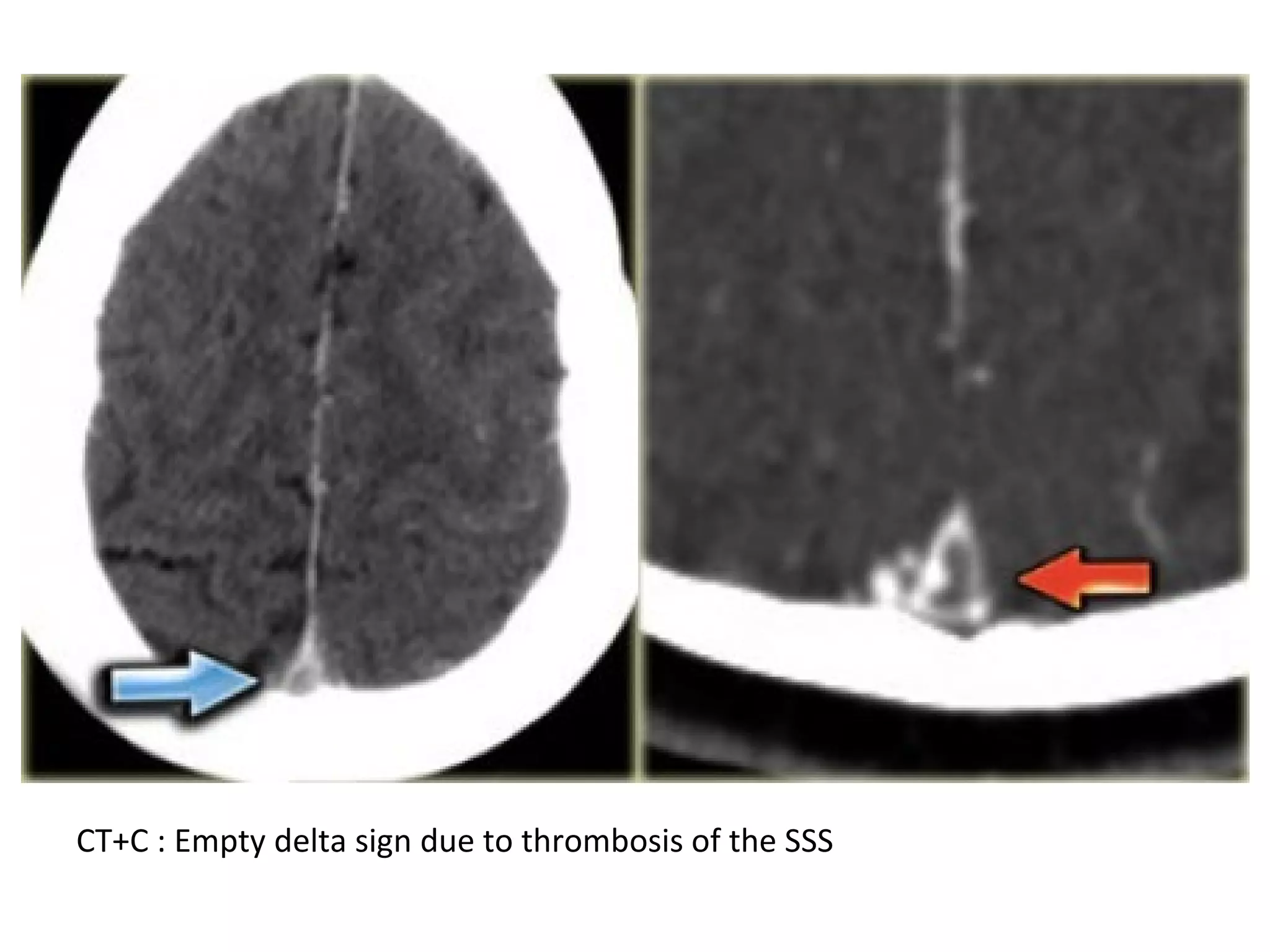 CT+C : Empty delta sign due to thrombosis of the SSS
 