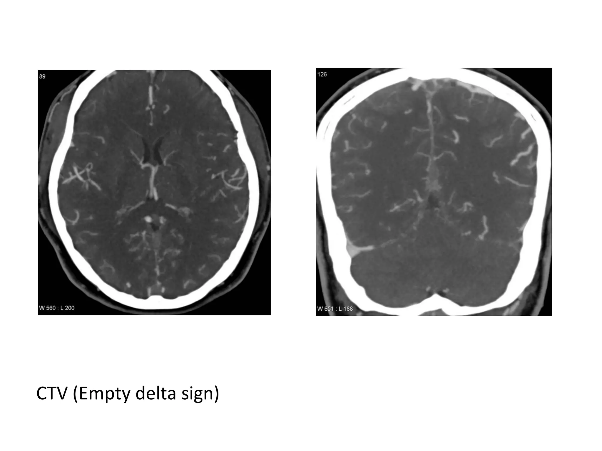 CTV (Empty delta sign)
 