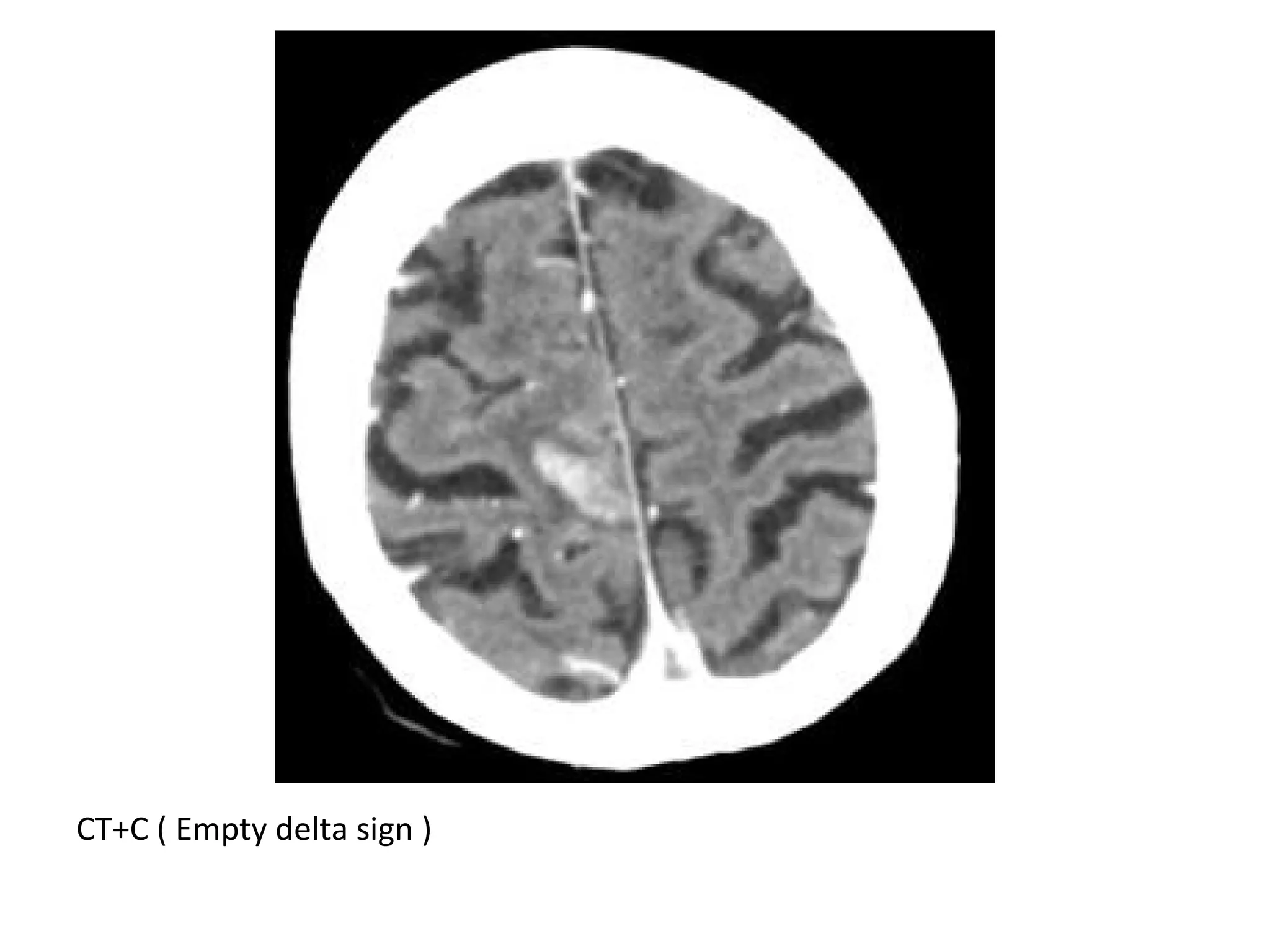 CT+C ( Empty delta sign )
 