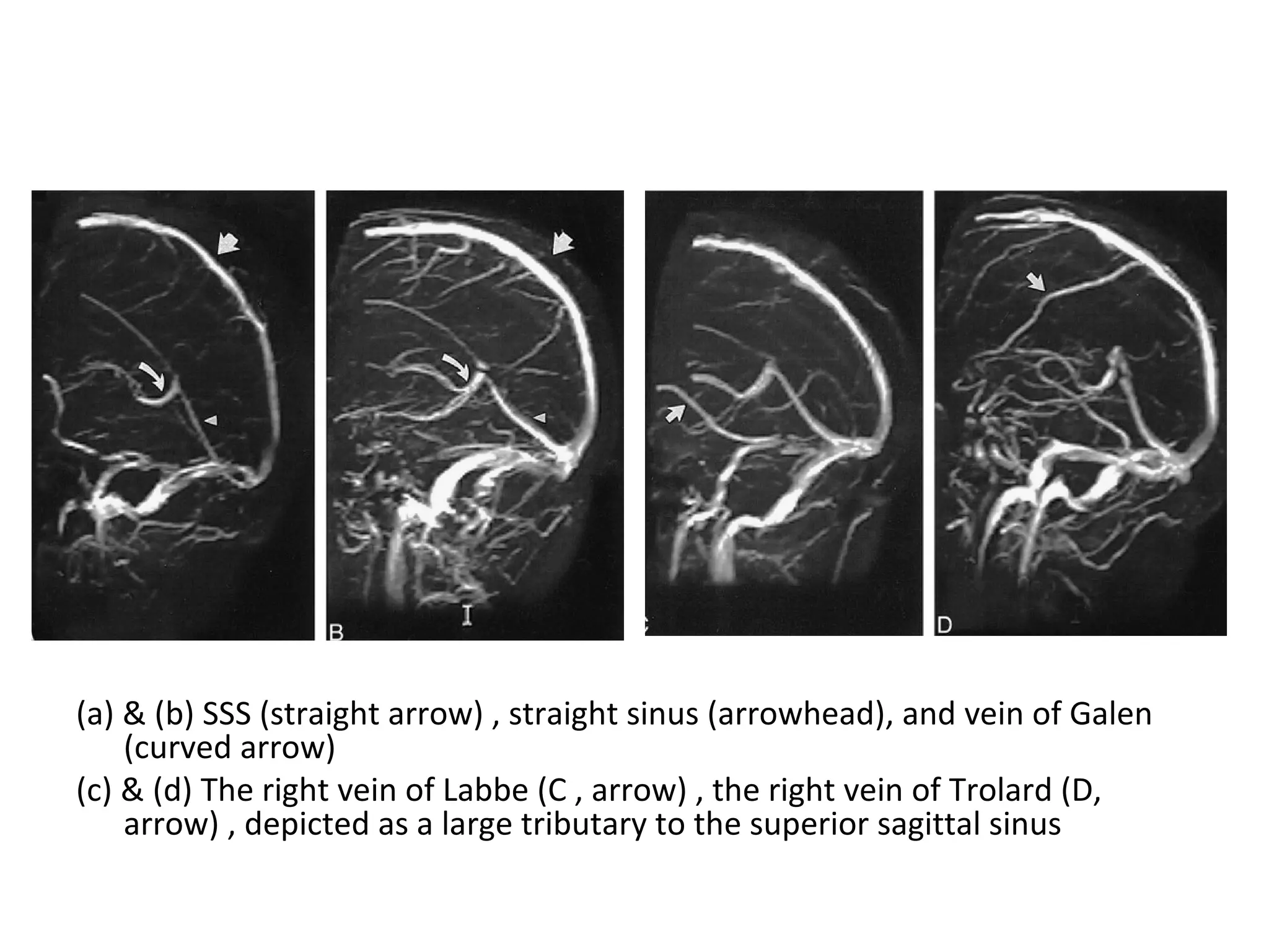 (a) & (b) SSS (straight arrow) , straight sinus (arrowhead), and vein of Galen
(curved arrow)
(c) & (d) The right vein of Labbe (C , arrow) , the right vein of Trolard (D,
arrow) , depicted as a large tributary to the superior sagittal sinus
 