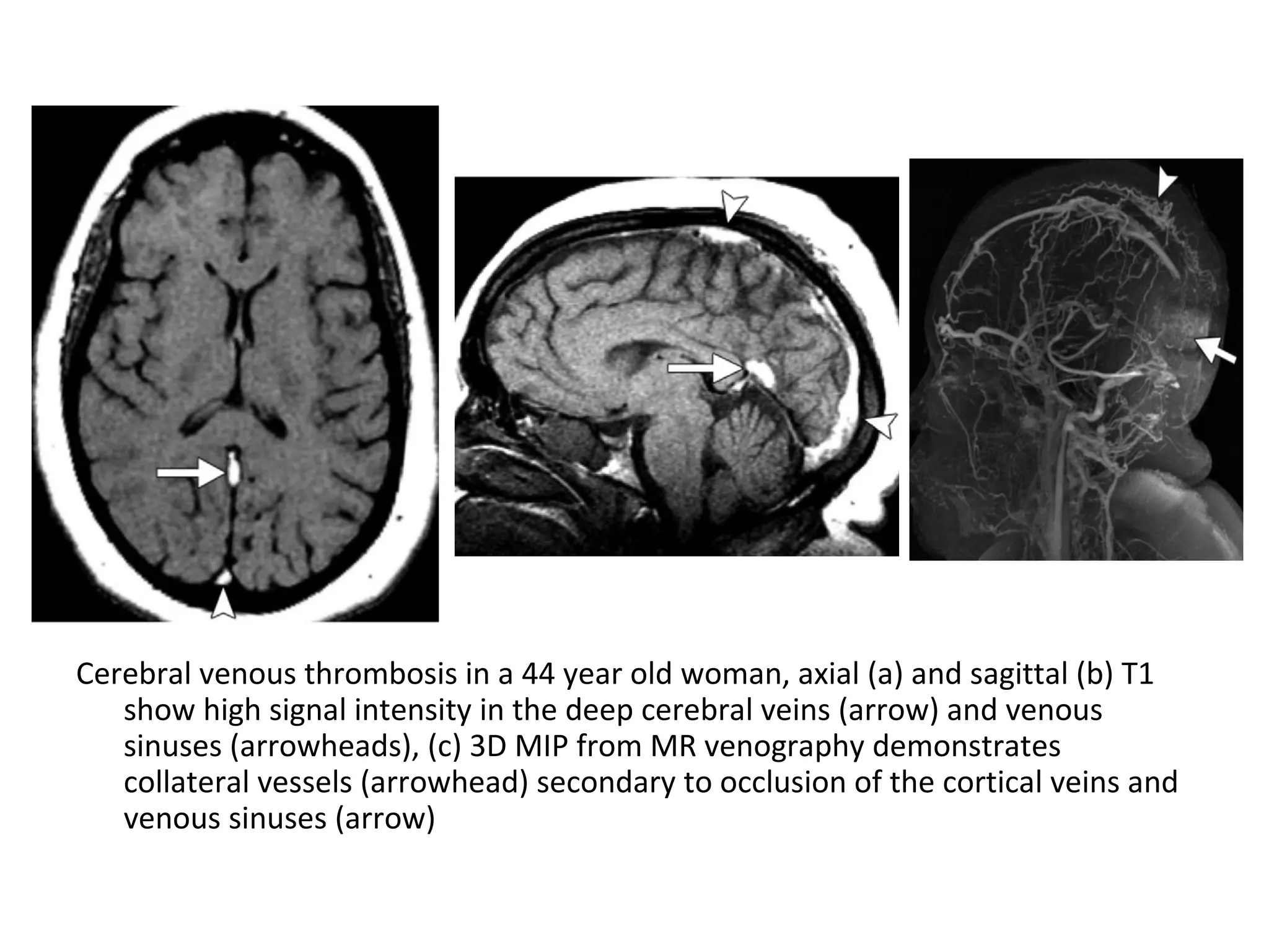 Cerebral venous thrombosis in a 44 year old woman, axial (a) and sagittal (b) T1
show high signal intensity in the deep cerebral veins (arrow) and venous
sinuses (arrowheads), (c) 3D MIP from MR venography demonstrates
collateral vessels (arrowhead) secondary to occlusion of the cortical veins and
venous sinuses (arrow)
 