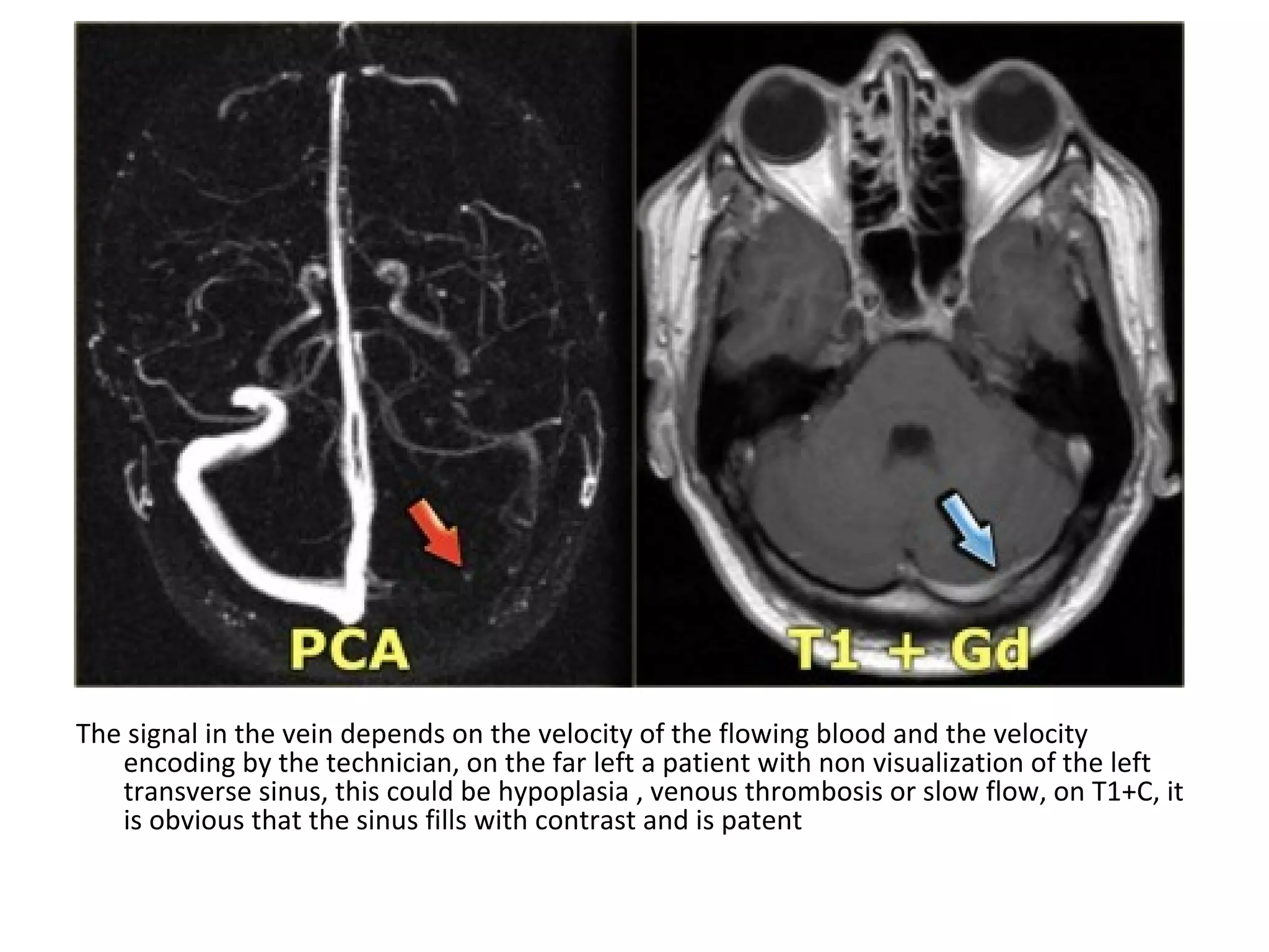 The signal in the vein depends on the velocity of the flowing blood and the velocity
encoding by the technician, on the far left a patient with non visualization of the left
transverse sinus, this could be hypoplasia , venous thrombosis or slow flow, on T1+C, it
is obvious that the sinus fills with contrast and is patent
 