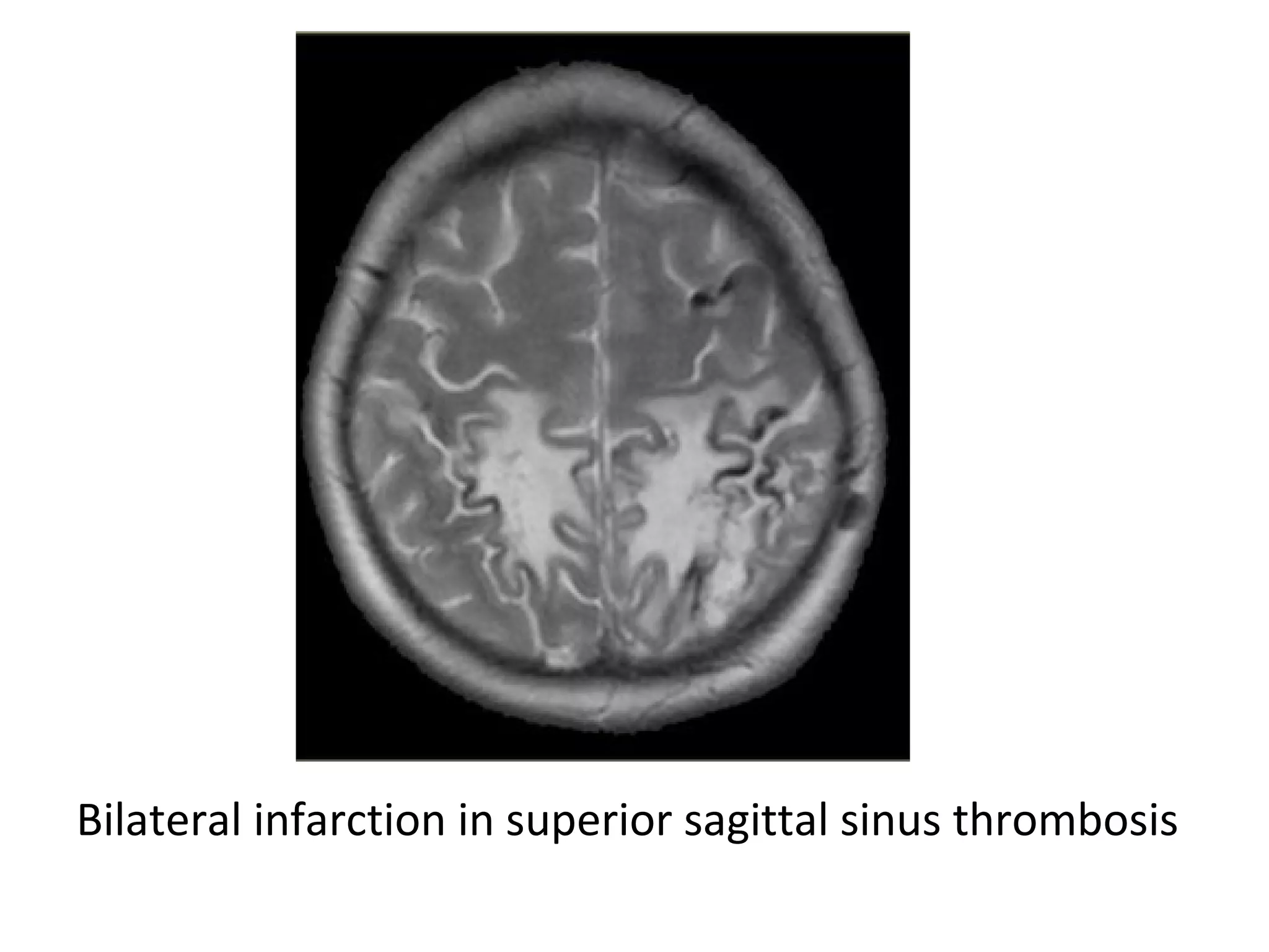Bilateral infarction in superior sagittal sinus thrombosis
 