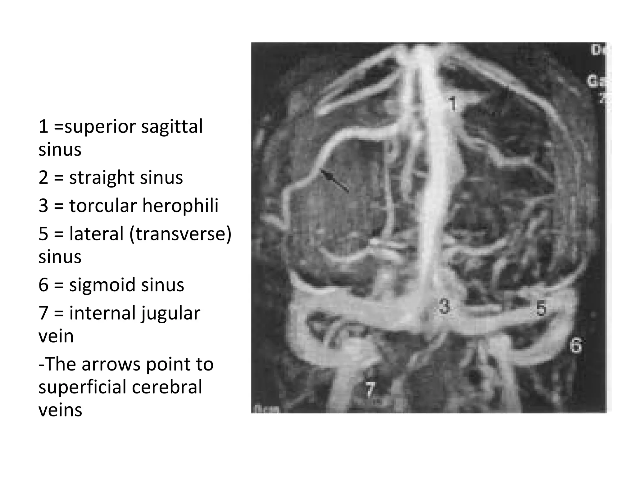 1 =superior sagittal
sinus
2 = straight sinus
3 = torcular herophili
5 = lateral (transverse)
sinus
6 = sigmoid sinus
7 = internal jugular
vein
-The arrows point to
superficial cerebral
veins
 