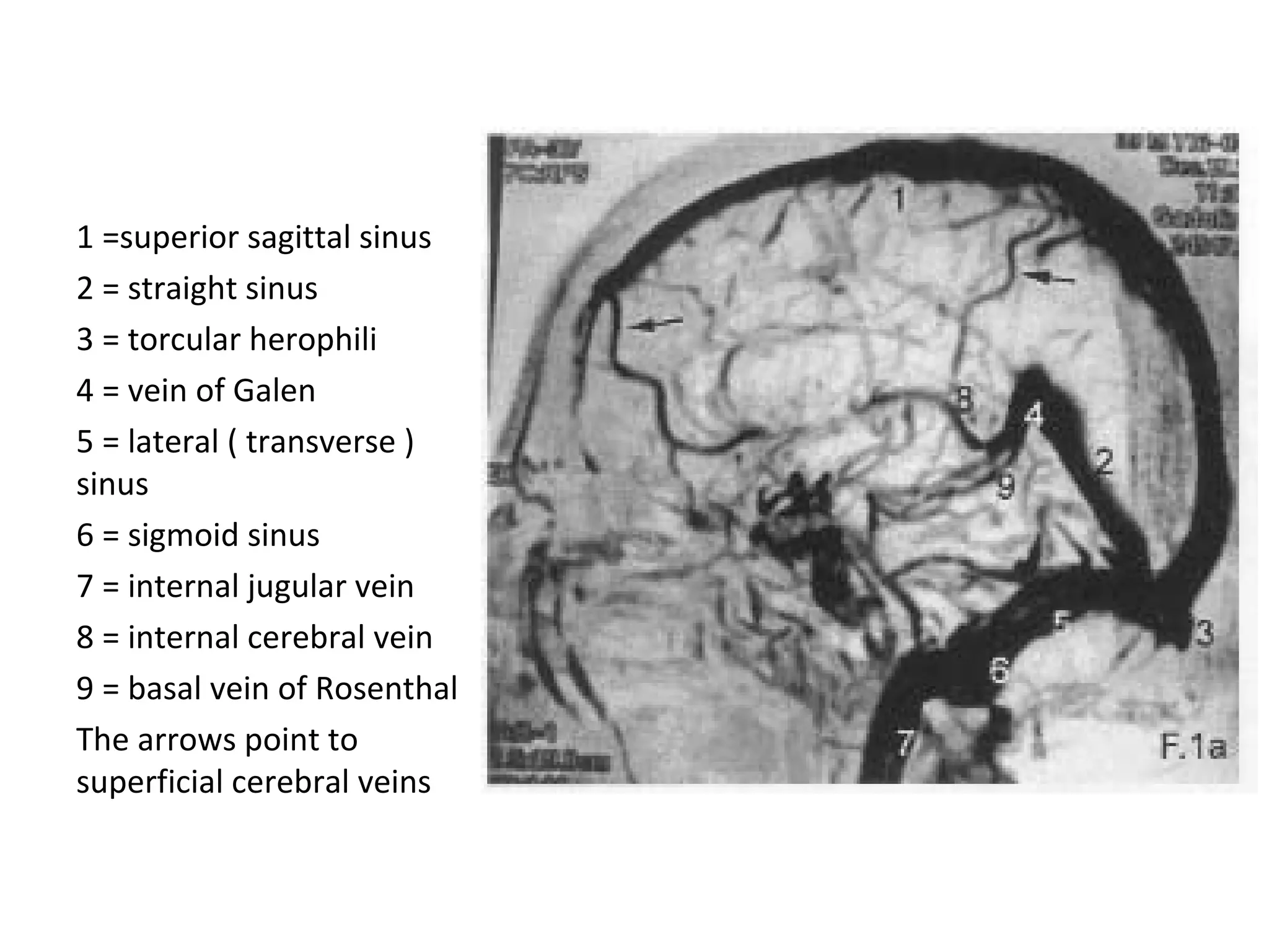 1 =superior sagittal sinus
2 = straight sinus
3 = torcular herophili
4 = vein of Galen
5 = lateral ( transverse )
sinus
6 = sigmoid sinus
7 = internal jugular vein
8 = internal cerebral vein
9 = basal vein of Rosenthal
The arrows point to
superficial cerebral veins
 