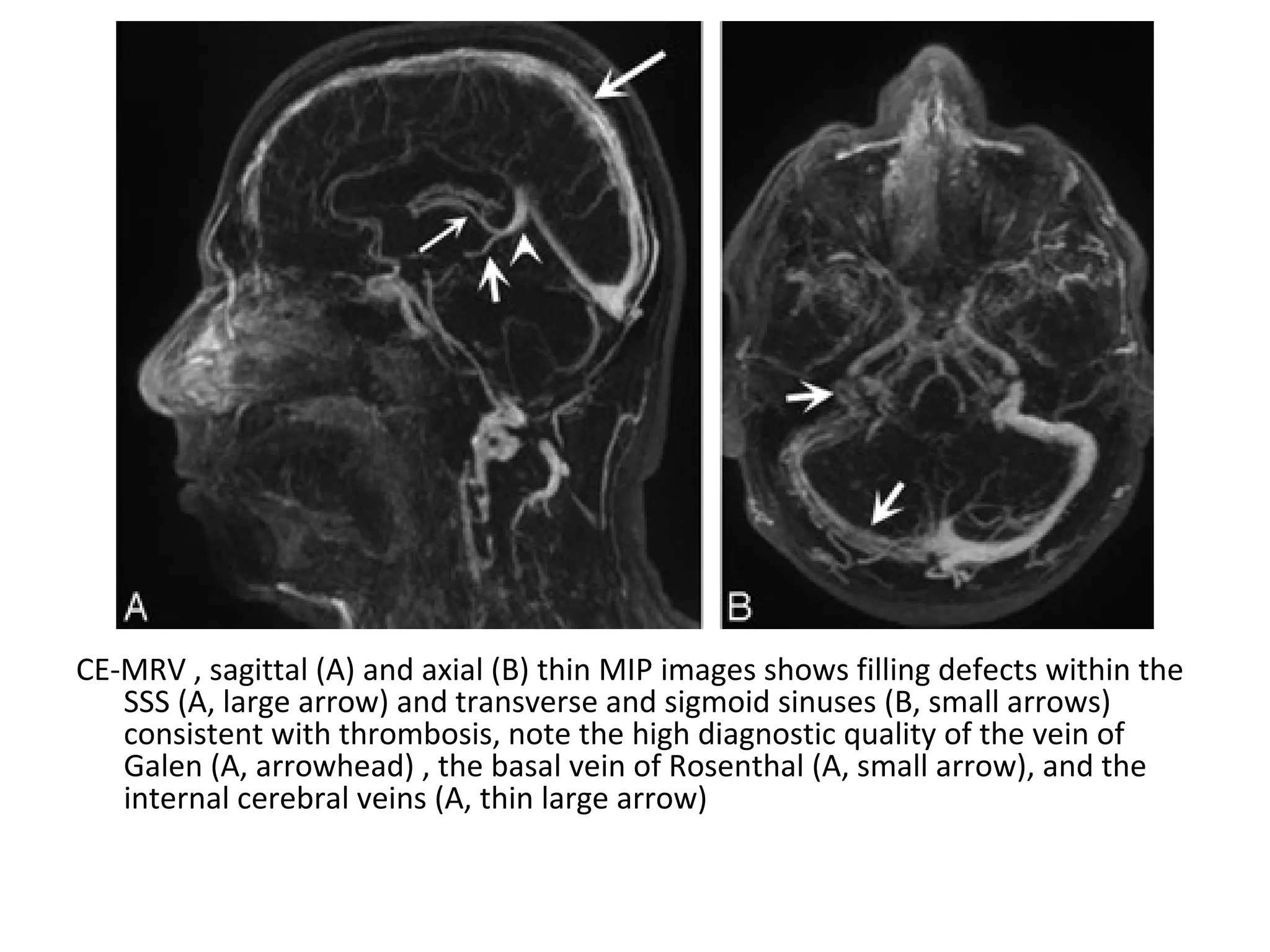 CE-MRV , sagittal (A) and axial (B) thin MIP images shows filling defects within the
SSS (A, large arrow) and transverse and sigmoid sinuses (B, small arrows)
consistent with thrombosis, note the high diagnostic quality of the vein of
Galen (A, arrowhead) , the basal vein of Rosenthal (A, small arrow), and the
internal cerebral veins (A, thin large arrow)
 