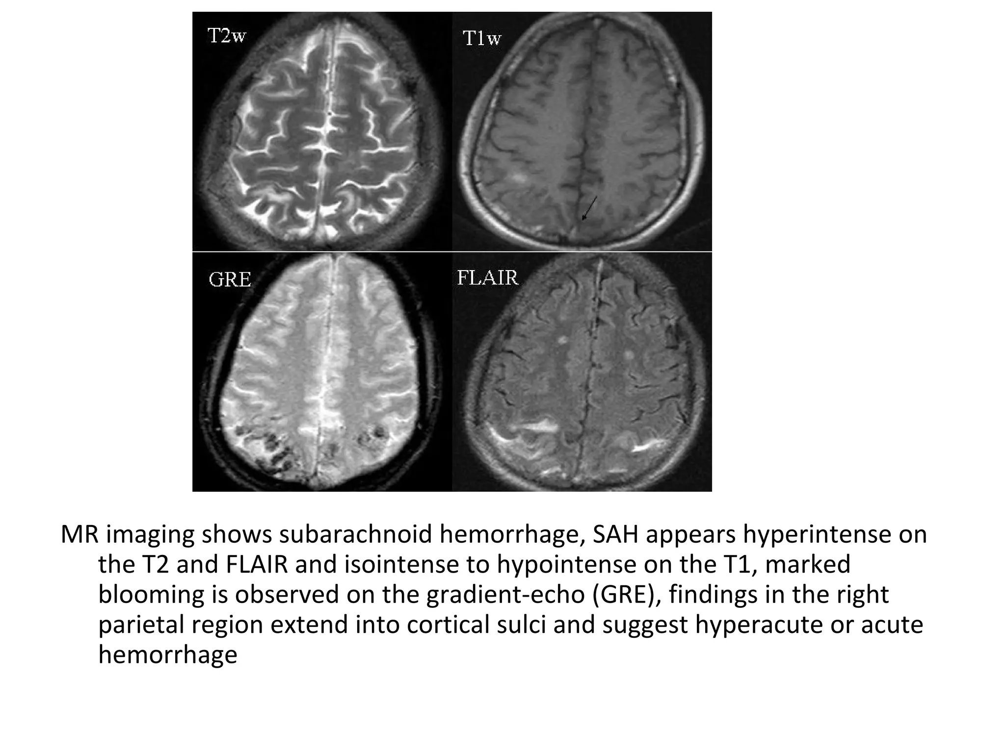 MR imaging shows subarachnoid hemorrhage, SAH appears hyperintense on
the T2 and FLAIR and isointense to hypointense on the T1, marked
blooming is observed on the gradient-echo (GRE), findings in the right
parietal region extend into cortical sulci and suggest hyperacute or acute
hemorrhage
 