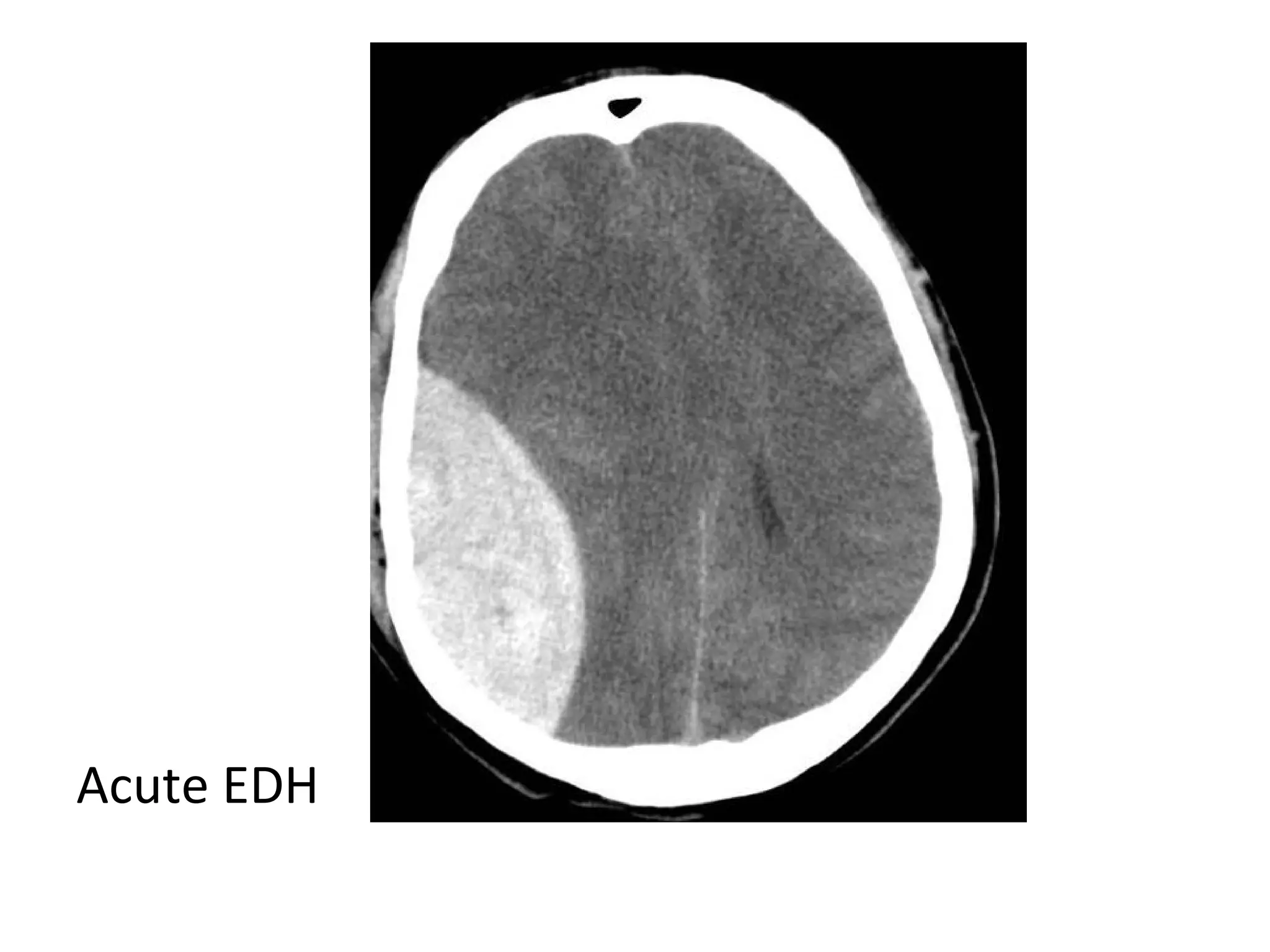 Acute EDH
 