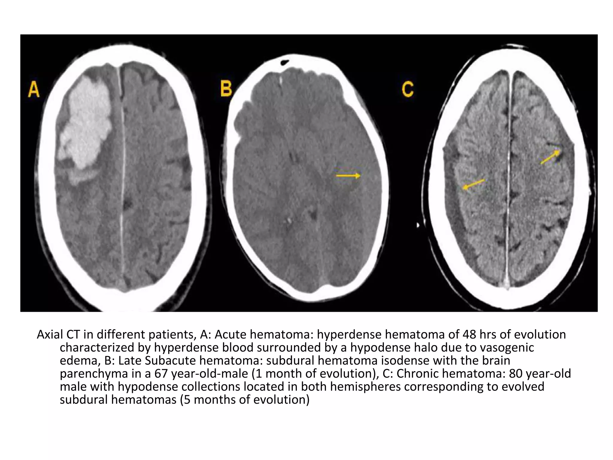 Axial CT in different patients, A: Acute hematoma: hyperdense hematoma of 48 hrs of evolution
characterized by hyperdense blood surrounded by a hypodense halo due to vasogenic
edema, B: Late Subacute hematoma: subdural hematoma isodense with the brain
parenchyma in a 67 year-old-male (1 month of evolution), C: Chronic hematoma: 80 year-old
male with hypodense collections located in both hemispheres corresponding to evolved
subdural hematomas (5 months of evolution)
 