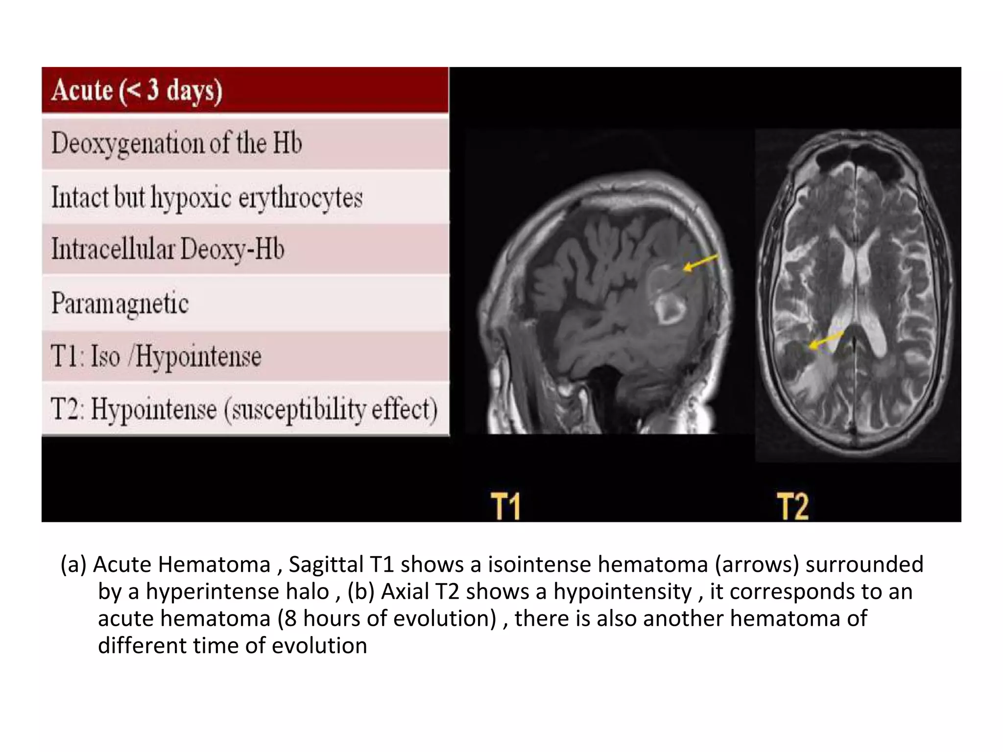 (a) Acute Hematoma , Sagittal T1 shows a isointense hematoma (arrows) surrounded
by a hyperintense halo , (b) Axial T2 shows a hypointensity , it corresponds to an
acute hematoma (8 hours of evolution) , there is also another hematoma of
different time of evolution
 