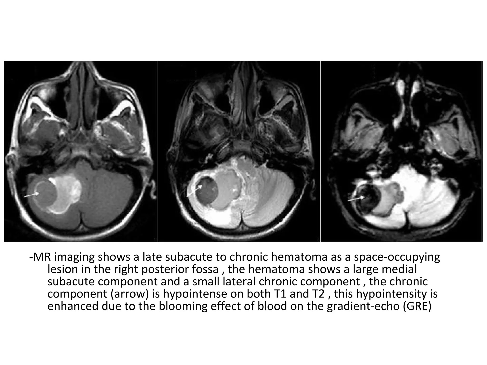 -MR imaging shows a late subacute to chronic hematoma as a space-occupying
lesion in the right posterior fossa , the hematoma shows a large medial
subacute component and a small lateral chronic component , the chronic
component (arrow) is hypointense on both T1 and T2 , this hypointensity is
enhanced due to the blooming effect of blood on the gradient-echo (GRE)
 