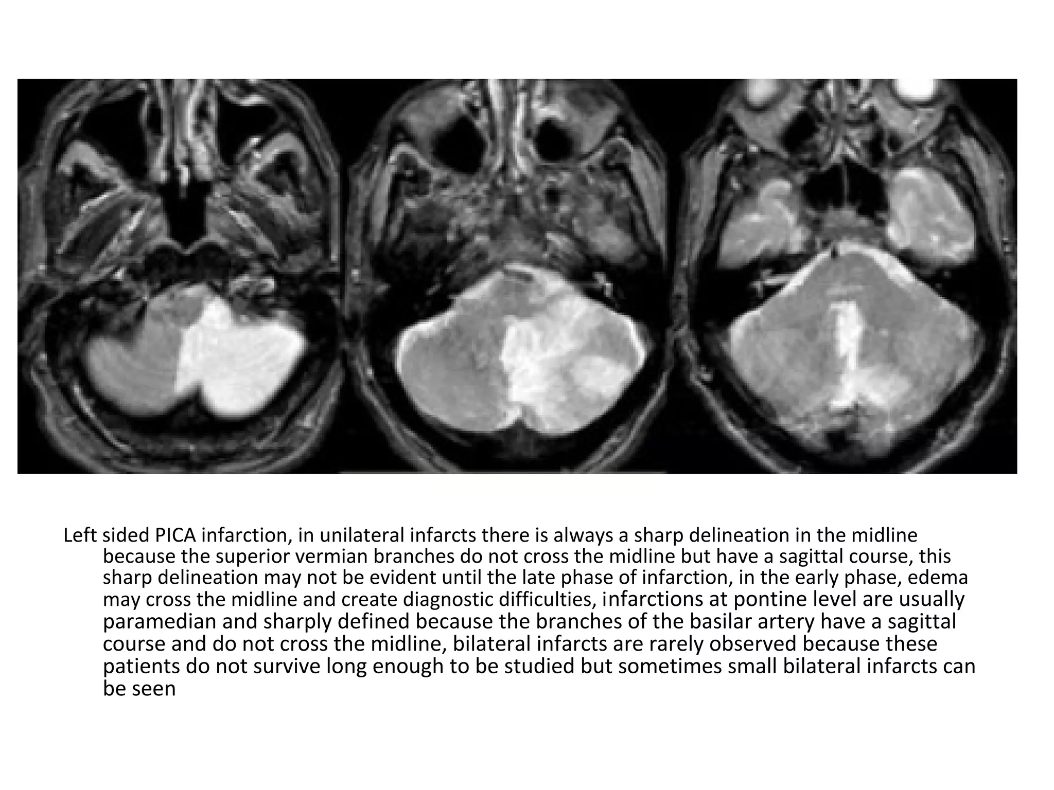 Left sided PICA infarction, in unilateral infarcts there is always a sharp delineation in the midline
because the superior vermian branches do not cross the midline but have a sagittal course, this
sharp delineation may not be evident until the late phase of infarction, in the early phase, edema
may cross the midline and create diagnostic difficulties, infarctions at pontine level are usually
paramedian and sharply defined because the branches of the basilar artery have a sagittal
course and do not cross the midline, bilateral infarcts are rarely observed because these
patients do not survive long enough to be studied but sometimes small bilateral infarcts can
be seen
 