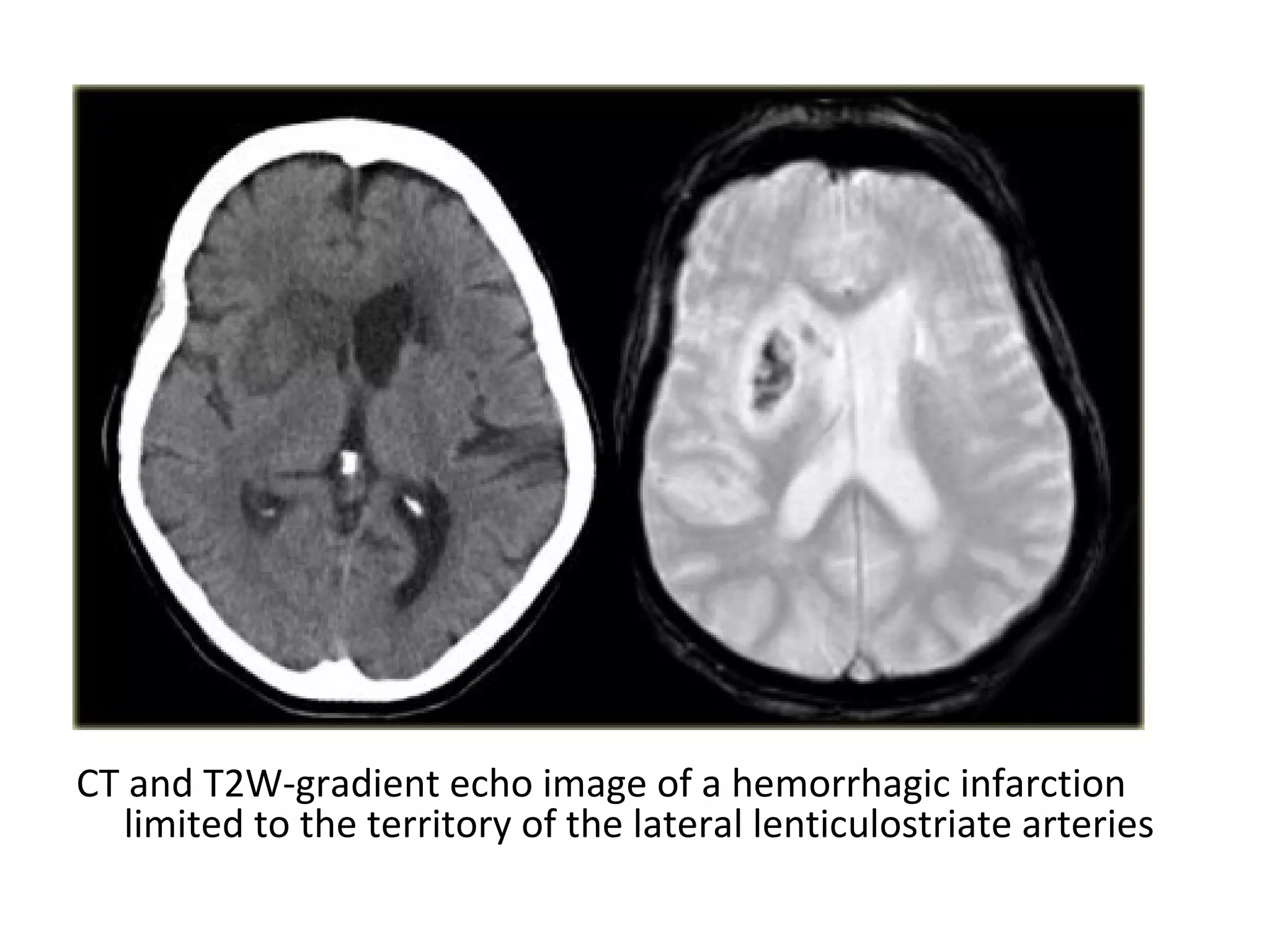CT and T2W-gradient echo image of a hemorrhagic infarction
limited to the territory of the lateral lenticulostriate arteries
 