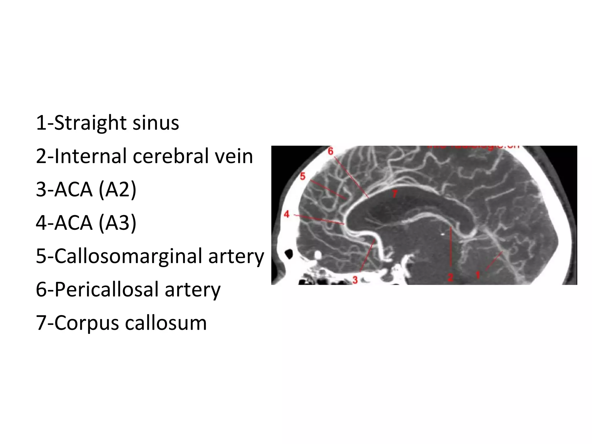 1-Straight sinus
2-Internal cerebral vein
3-ACA (A2)
4-ACA (A3)
5-Callosomarginal artery
6-Pericallosal artery
7-Corpus callosum
 