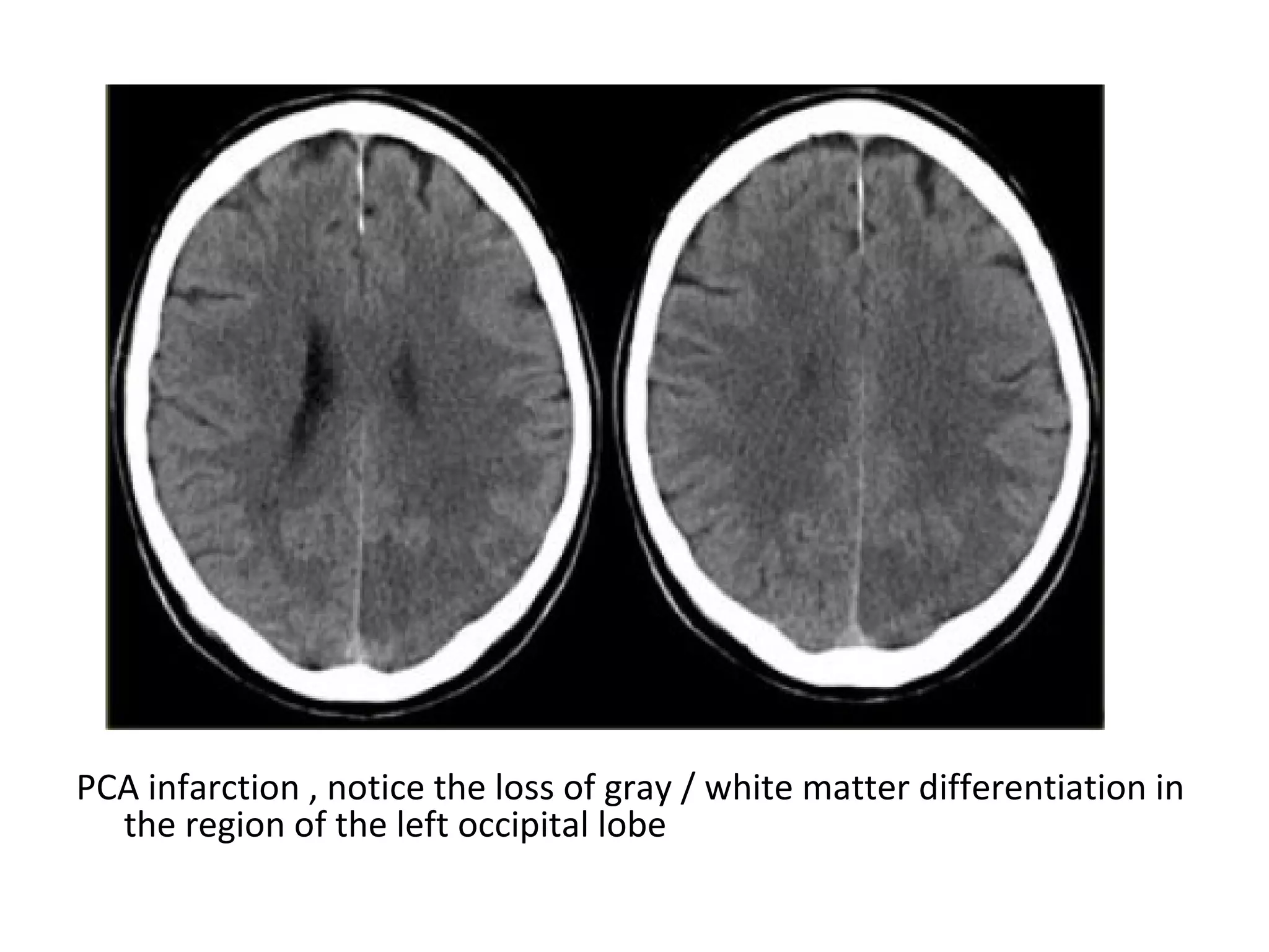 PCA infarction , notice the loss of gray / white matter differentiation in
the region of the left occipital lobe
 