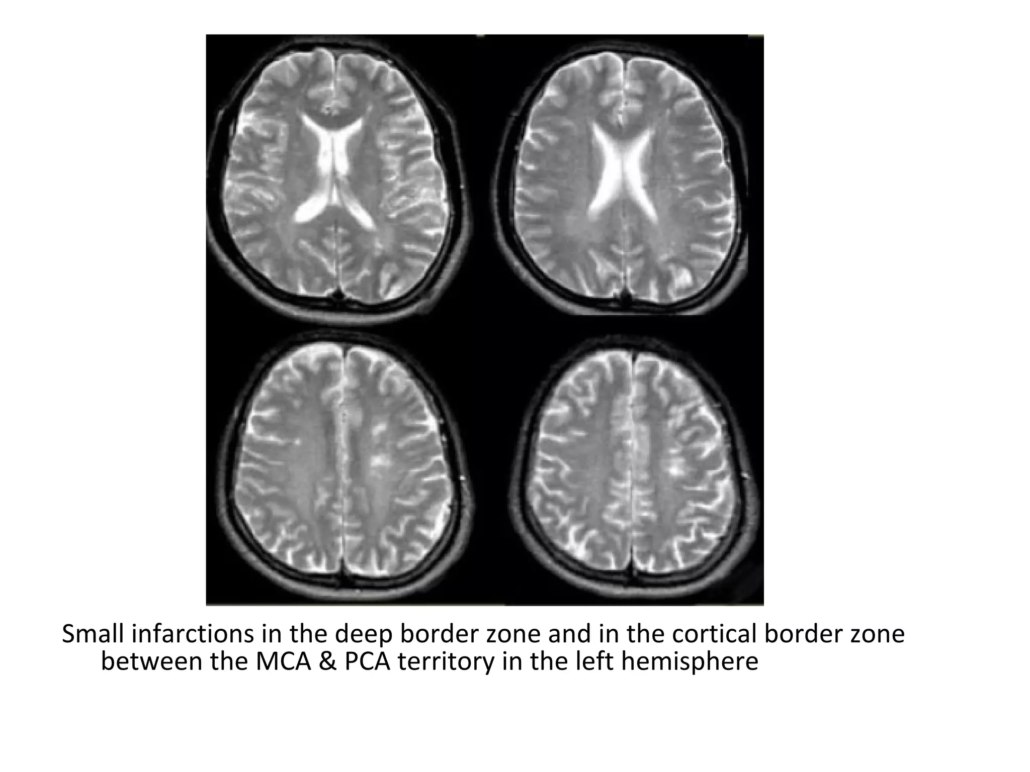 Small infarctions in the deep border zone and in the cortical border zone
between the MCA & PCA territory in the left hemisphere
 