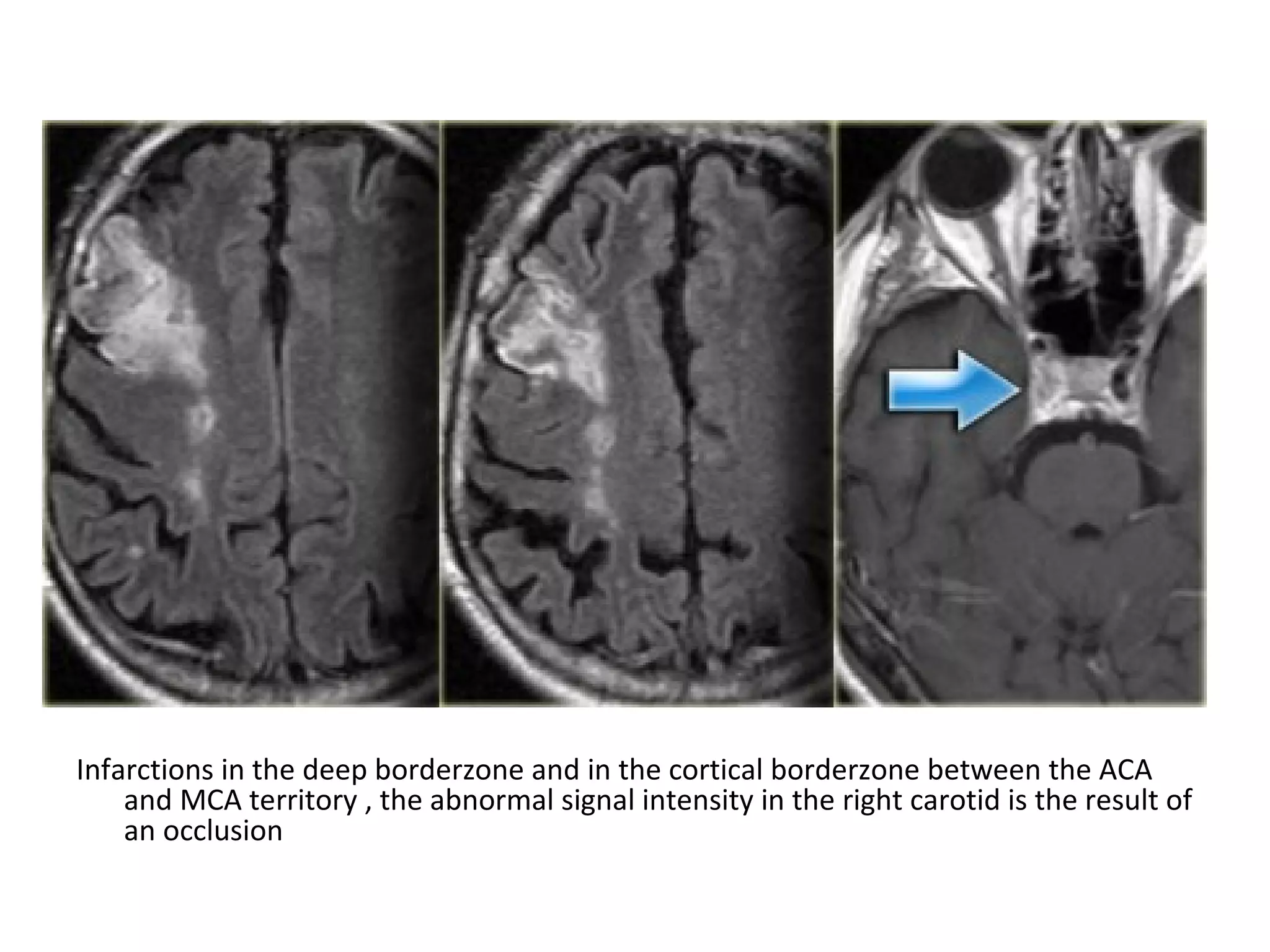 Infarctions in the deep borderzone and in the cortical borderzone between the ACA
and MCA territory , the abnormal signal intensity in the right carotid is the result of
an occlusion
 