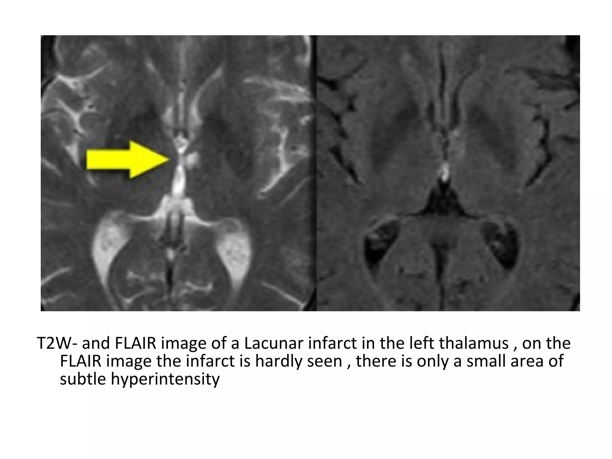 T2W- and FLAIR image of a Lacunar infarct in the left thalamus , on the
FLAIR image the infarct is hardly seen , there is only a small area of
subtle hyperintensity
 