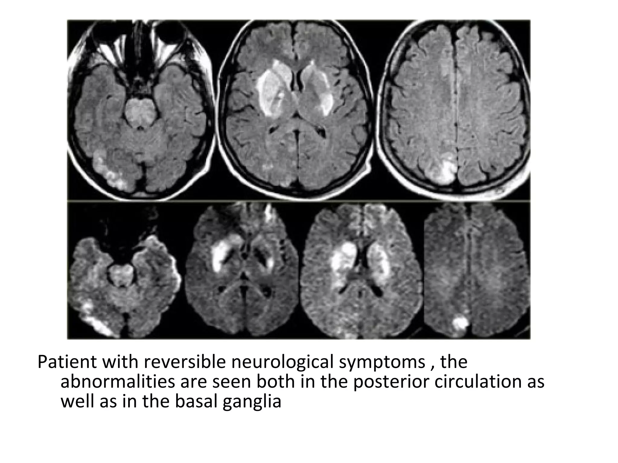 Patient with reversible neurological symptoms , the
abnormalities are seen both in the posterior circulation as
well as in the basal ganglia
 