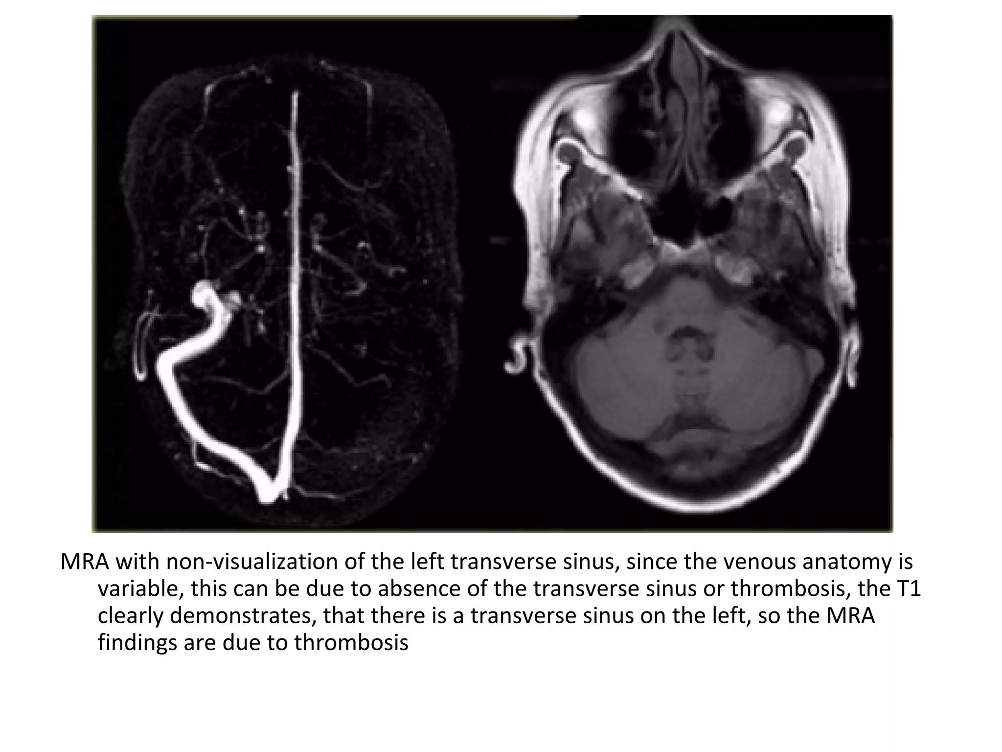 MRA with non-visualization of the left transverse sinus, since the venous anatomy is
variable, this can be due to absence of the transverse sinus or thrombosis, the T1
clearly demonstrates, that there is a transverse sinus on the left, so the MRA
findings are due to thrombosis
 
