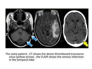 The same patient , CT shows the dense thrombosed transverse
sinus (yellow arrow) , the FLAIR shows the venous infarction
in the temporal lobe
 