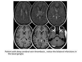 Patient with deep cerebral vein thrombosis , notice the bilateral infarctions in
the basal ganglia
 
