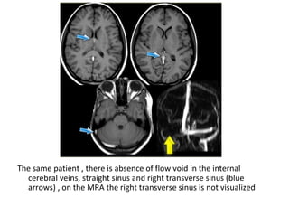 The same patient , there is absence of flow void in the internal
cerebral veins, straight sinus and right transverse sinus (blue
arrows) , on the MRA the right transverse sinus is not visualized
 