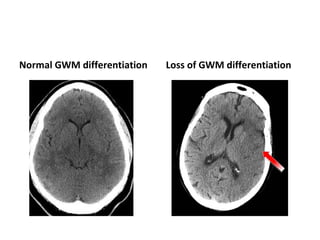 Normal GWM differentiation Loss of GWM differentiation
 