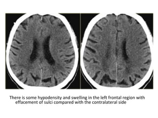 There is some hypodensity and swelling in the left frontal region with
effacement of sulci compared with the contralateral side
 