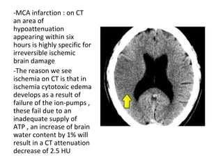 -MCA infarction : on CT
an area of
hypoattenuation
appearing within six
hours is highly specific for
irreversible ischemic
brain damage
-The reason we see
ischemia on CT is that in
ischemia cytotoxic edema
develops as a result of
failure of the ion-pumps ,
these fail due to an
inadequate supply of
ATP , an increase of brain
water content by 1% will
result in a CT attenuation
decrease of 2.5 HU
 